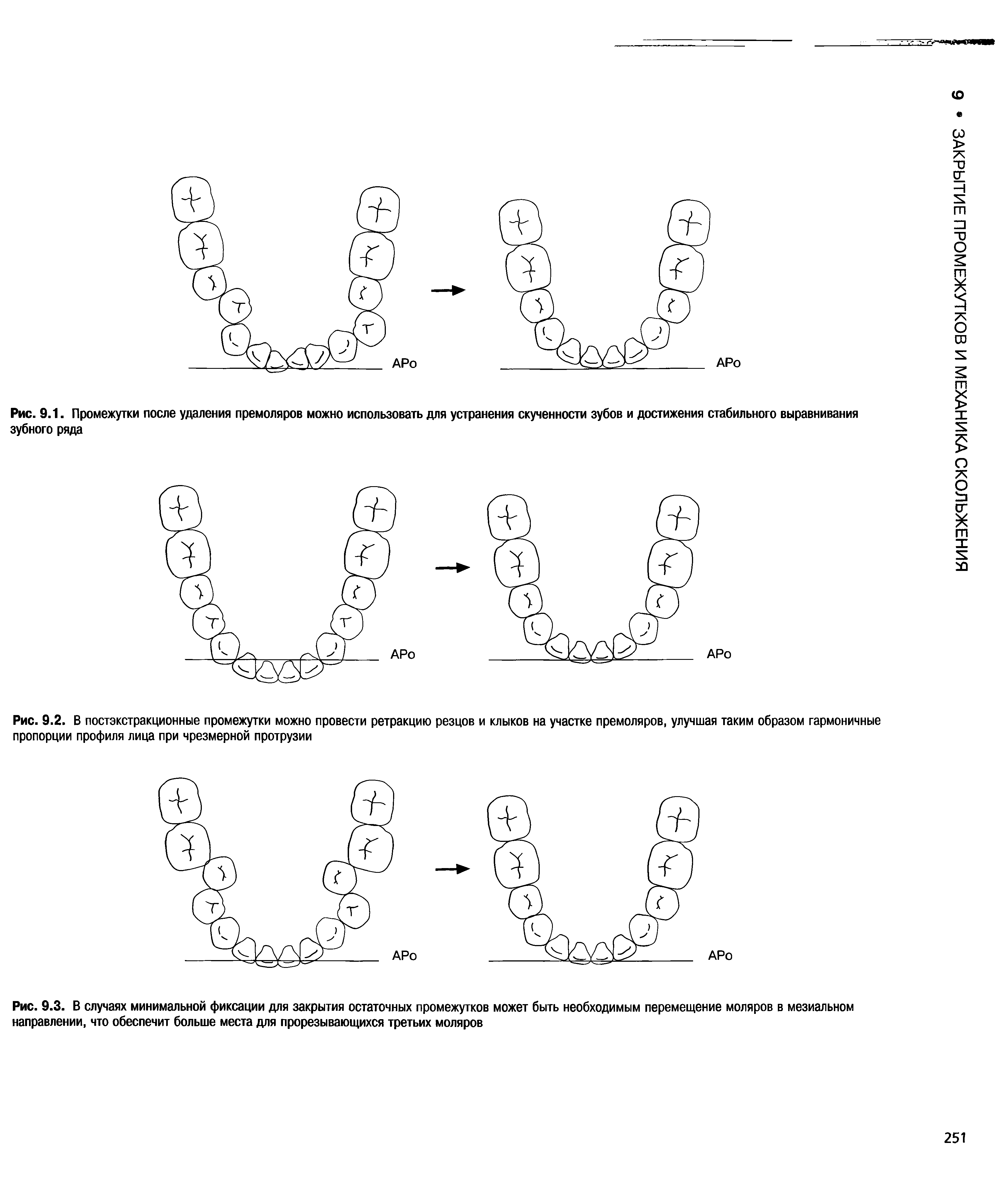 Рис. 9.2. В постэкстракционные промежутки можно провести ретракцию резцов и клыков на участке премоляров, улучшая таким образом гармоничные пропорции профиля лица при чрезмерной протрузии...