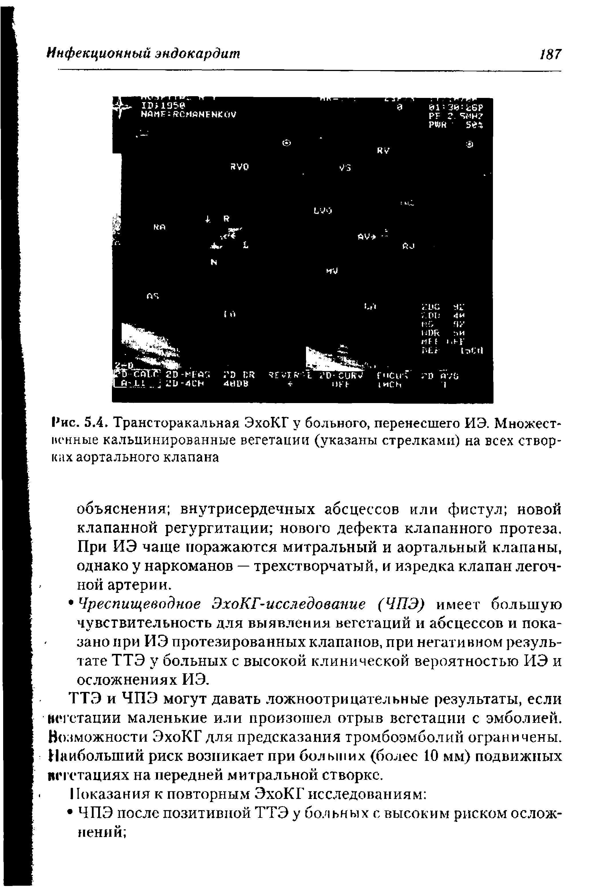 Рис. 5.4. Трансторакальная ЭхоКГ у больного, перенесшего ИЭ. Множест-иенные кальцинированные вегетации (указаны стрелками) на всех створках аортального клапана...