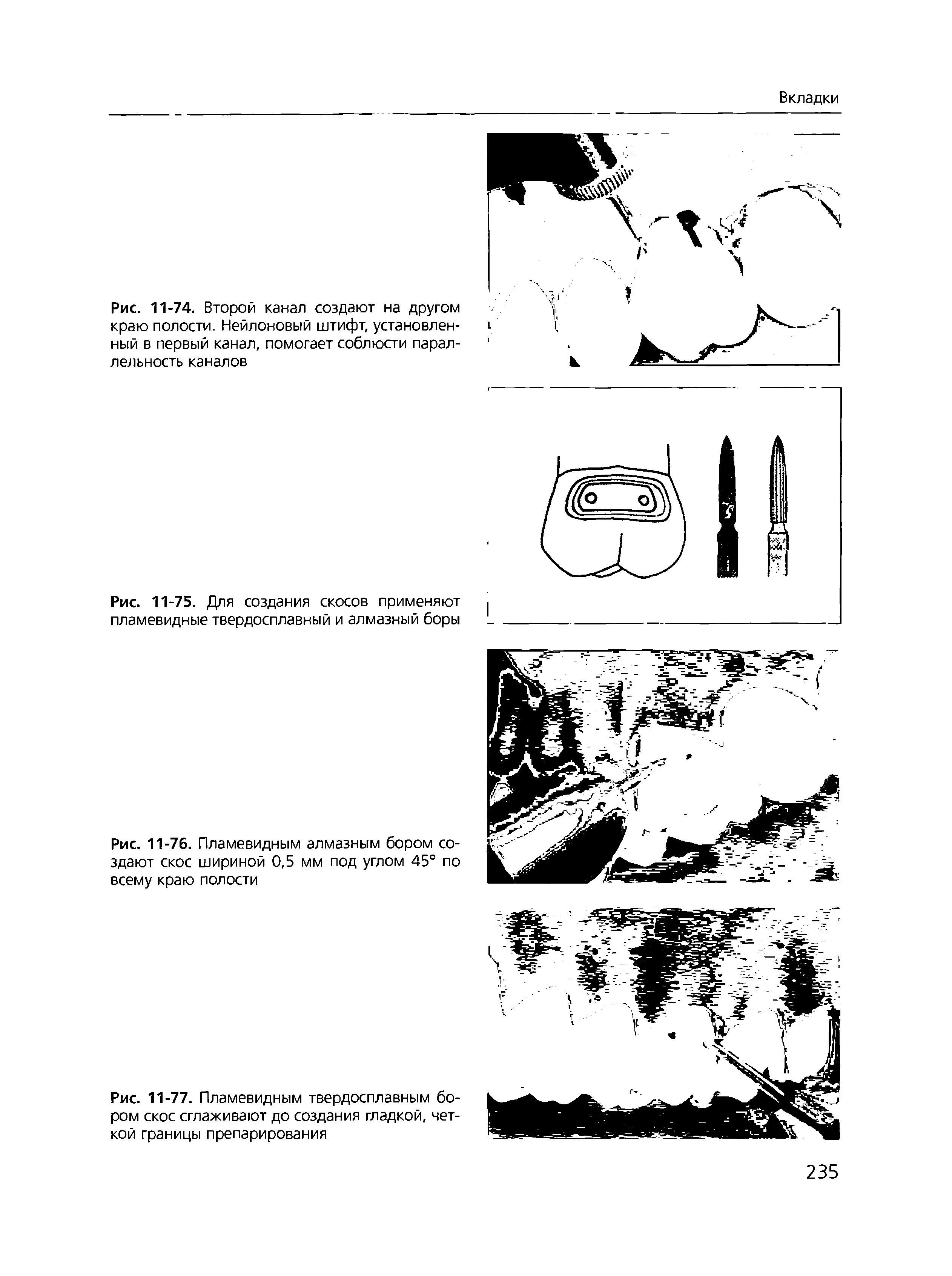 Рис. 11-77. Пламевидным твердосплавным бором скос сглаживают до создания гладкой, четкой границы препарирования...