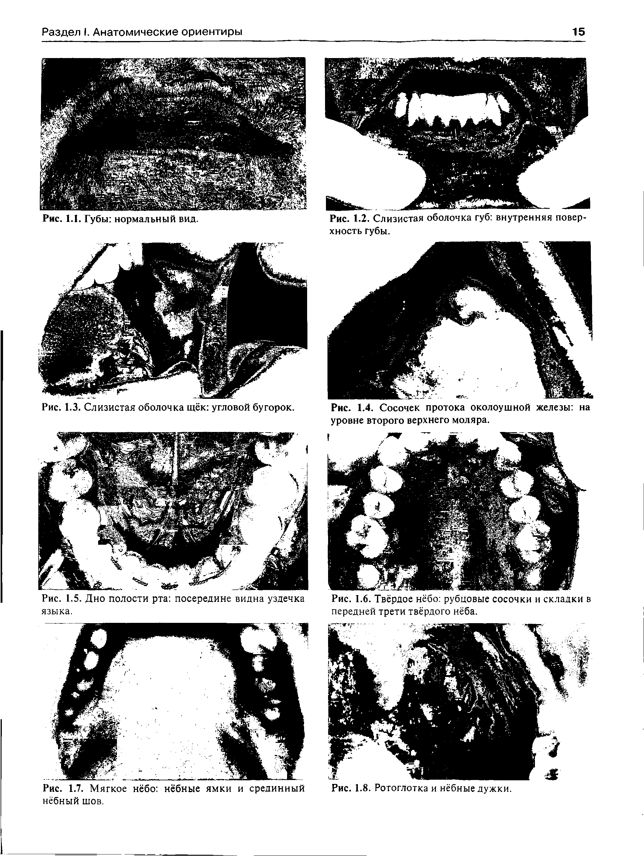 Рис. 1.3. Слизистая оболочка щёк угловой бугорок. Рис. 1.4. Сосочек протока околоушной железы на...