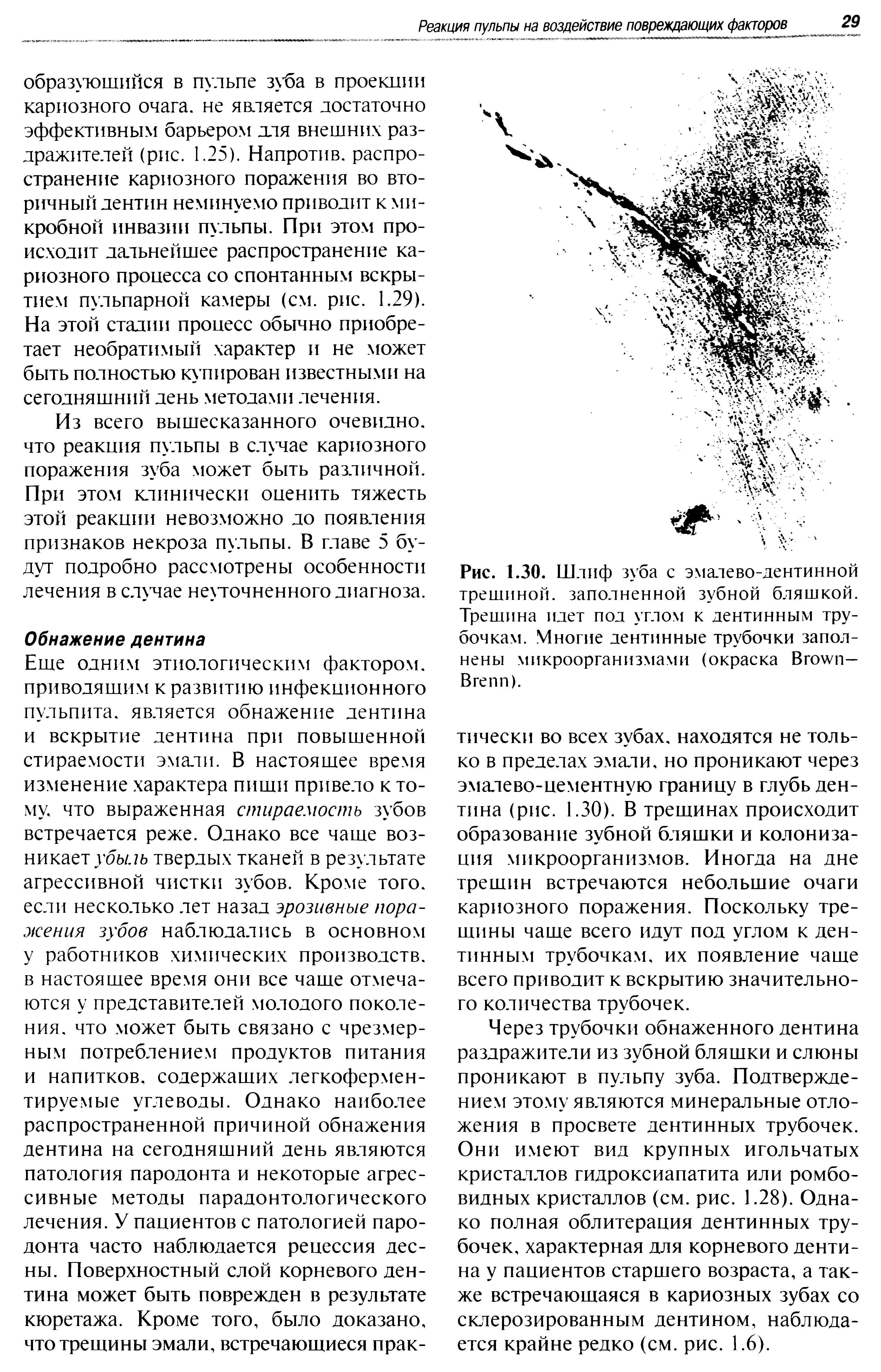 Рис. 1.30. Шлиф зуба с эмалево-дентинной трешиной. заполненной зубной бляшкой. Трещина идет под углом к дентинным трубочкам. Многие дентинные трубочки заполнены микроорганизмами (окраска B — B ).