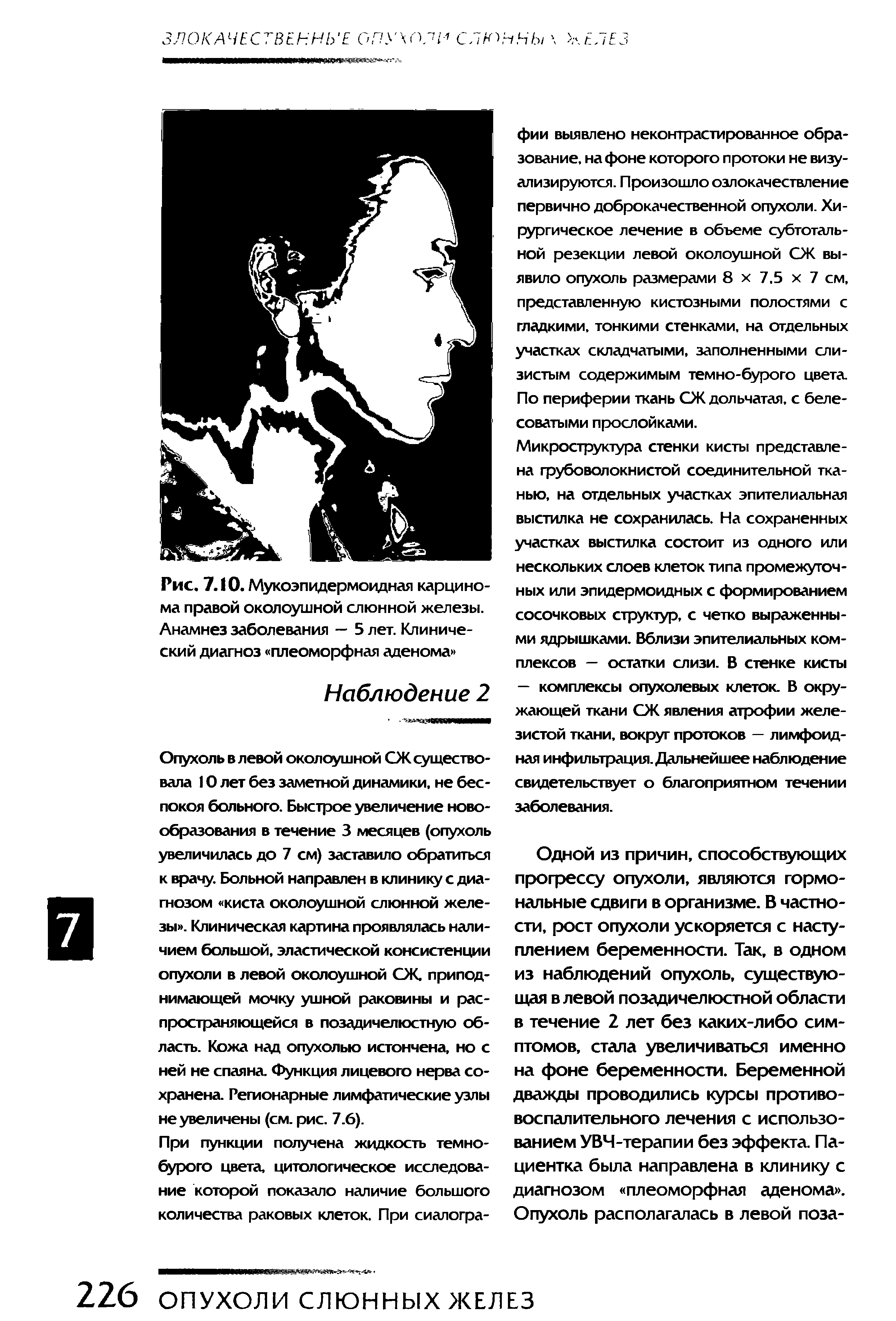 Рис. 7.10. Мукоэпидермоидная карцинома правой околоушной слюнной железы. Анамнез заболевания — 5 лет. Клинический диагноз плеоморфная аденома ...