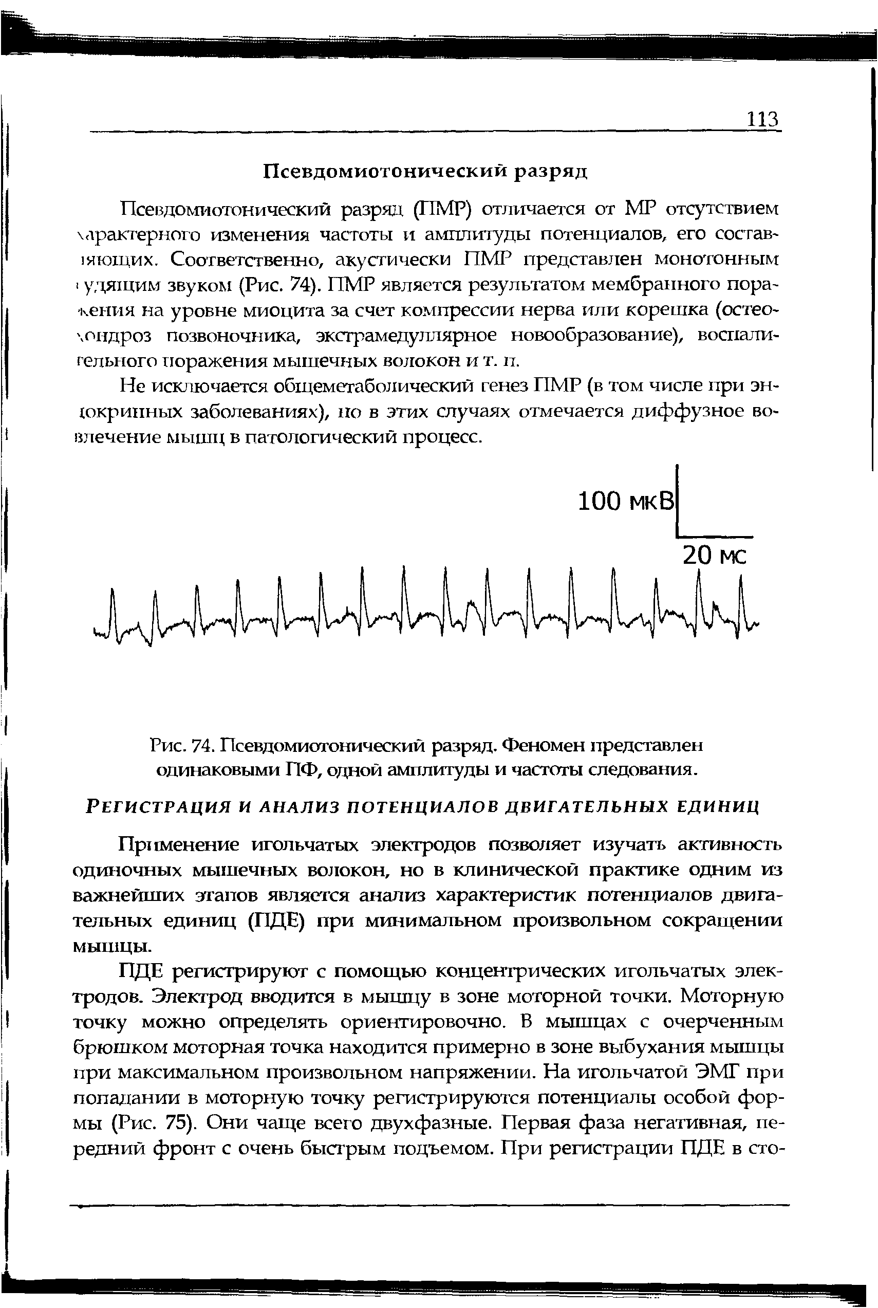 Рис. 74. Псевдомиотонический разряд. Феномен представлен одинаковыми ПФ, одной амплитуды и частоты следования.