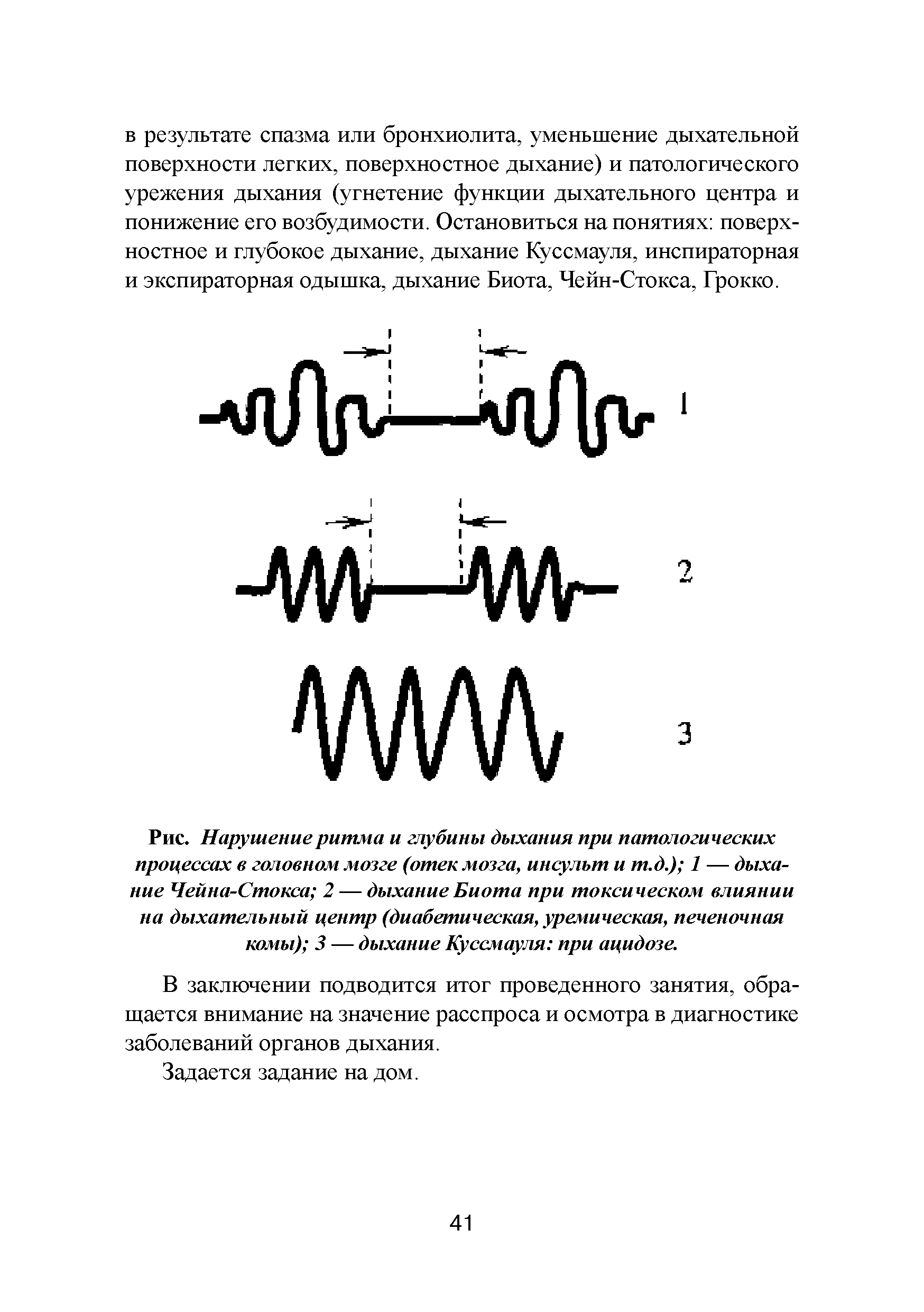 Рис. Нарушение ритма и глубины дыхания при патологических процессах в головном мозге (отек мозга, инсульт и т.д.) 1 — дыхание Чейна-Стокса 2 — дыхание Биота при токсическом влиянии на дыхательный центр (диабетическая, уремическая, печеночная комы) 3 — дыхание Куссмауля при ацидозе.