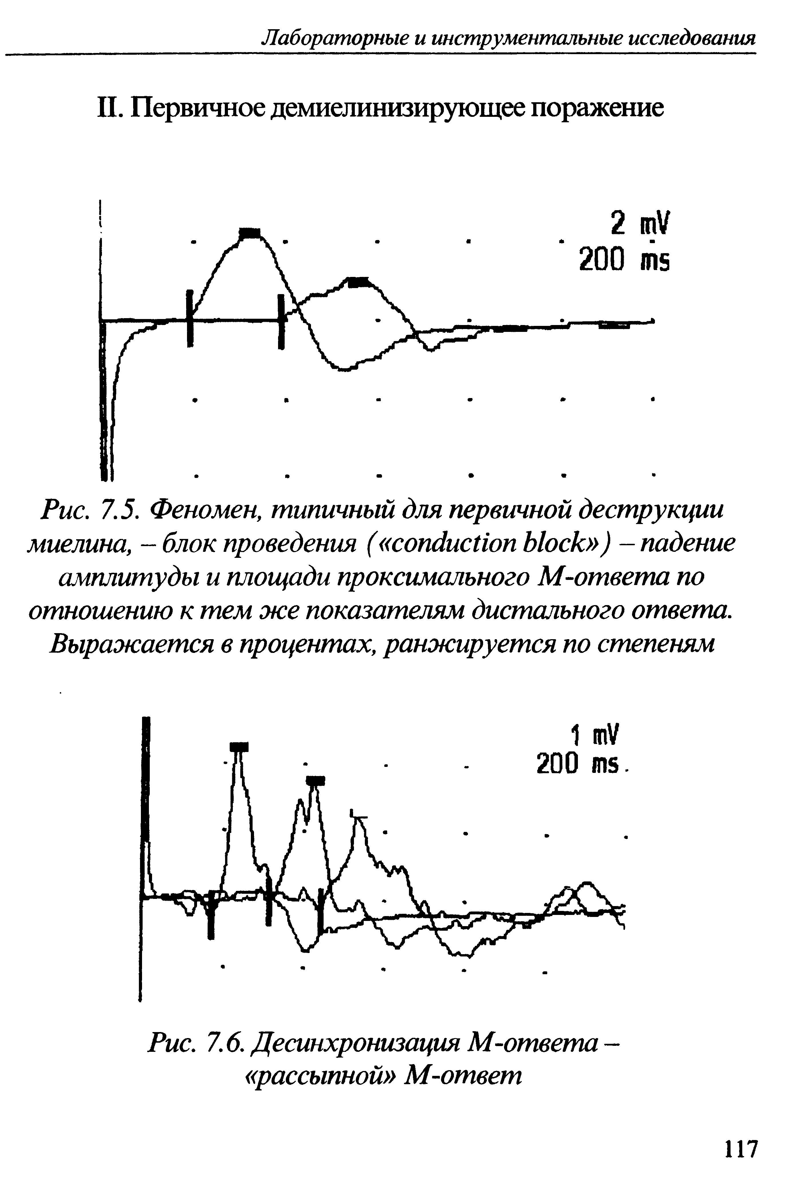 Рис. 7.5. Феномен, типичный для первичной деструкции миелина, - блок проведения ( ) — падение амплитуды и площади проксимального М-ответа по отношению к тем же показателям дистального ответа. Выражается в процентах, ранжируется по степеням...