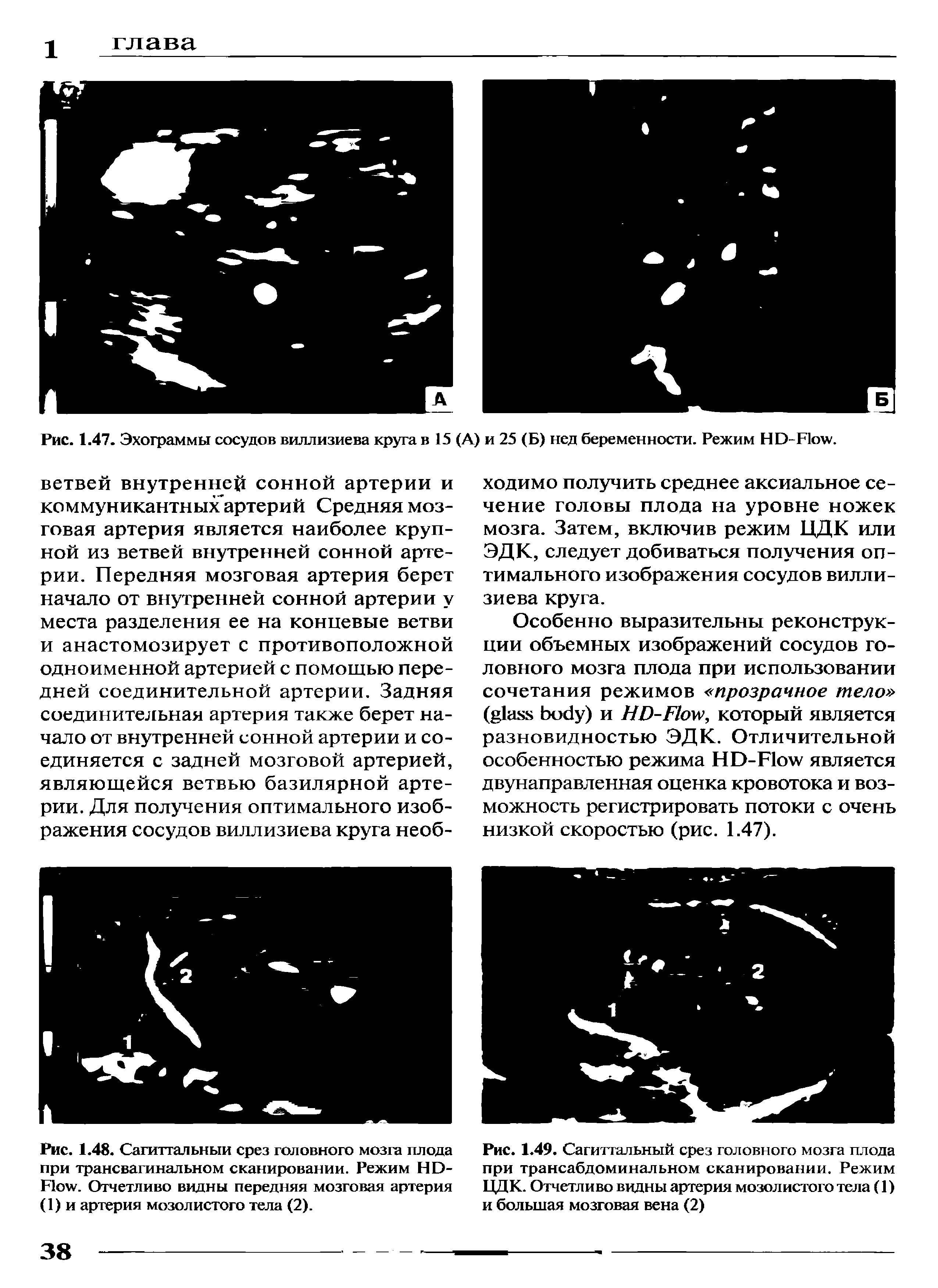 Рис. 1.48. Сагиттальный срез головного мозга плода при трансвагинальном сканировании. Режим НО-Ноуу. Отчетливо видны передняя мозговая артерия (1) и артерия мозолистого тела (2).