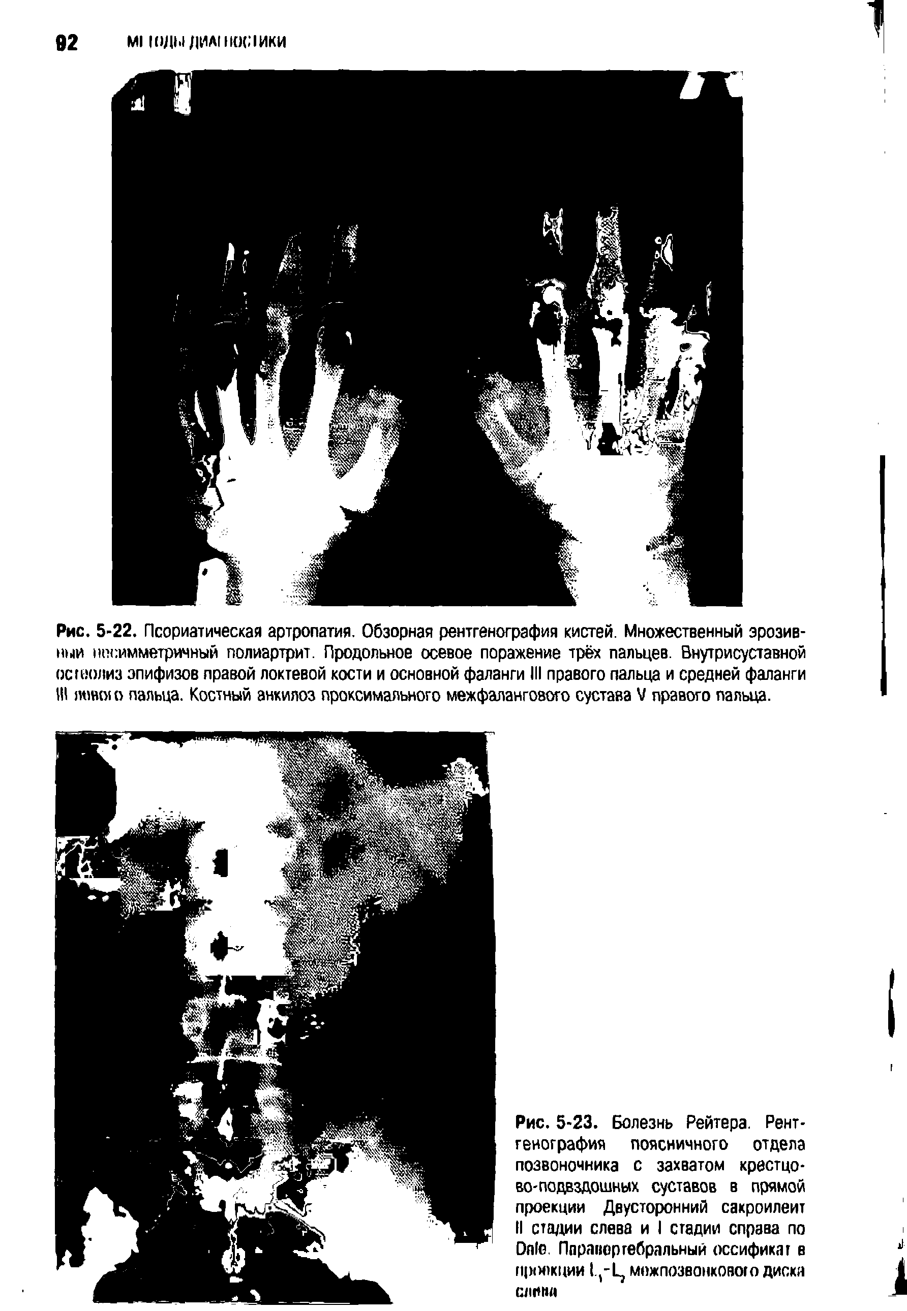 Рис. 5-22. Псориатическая артропатия. Обзорная рентгенография кистей. Множественный эрозивный ппсимметричный полиартрит. Продольное осевое поражение трёх пальцев. Внутрисуставной ос лиз эпифизов правой локтевой кости и основной фаланги III правого пальца и средней фаланги III левою пальца. Костный анкилоз проксимального межфалангового сустава V правого пальца.