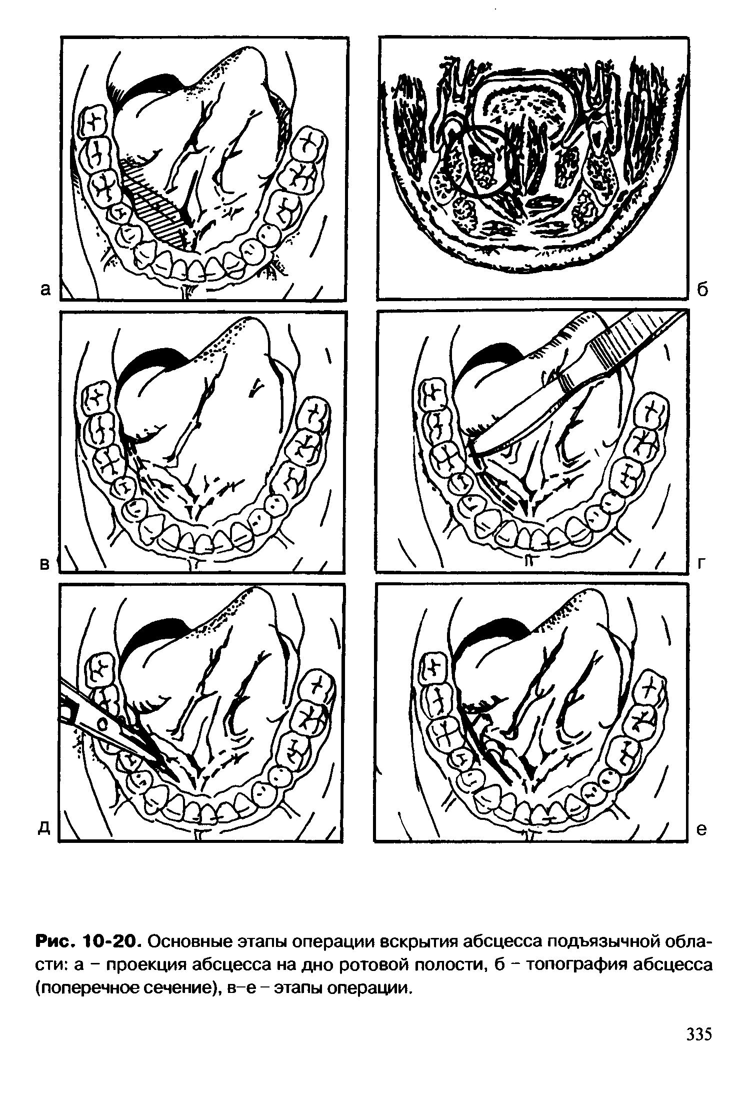 Рис. 10-20. Основные этапы операции вскрытия абсцесса подъязычной области а - проекция абсцесса на дно ротовой полости, б - топография абсцесса (поперечное сечение), в-е - этапы операции.