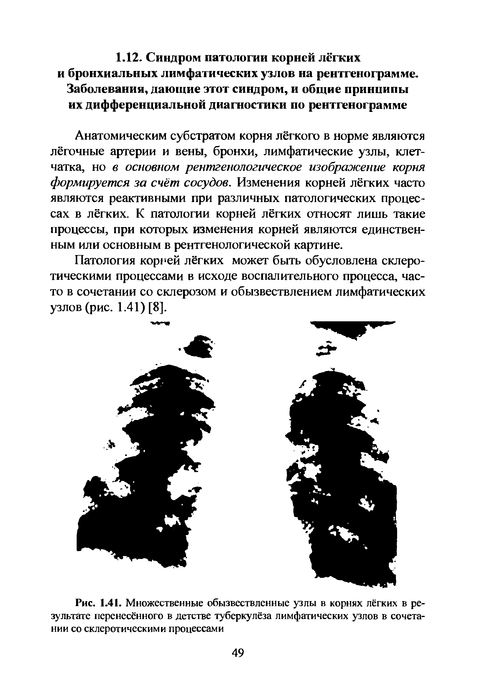 Рис. 1.41. Множественные обызвествленные узлы в корнях лёгких в результате перенесённого в детстве туберкулёза лимфатических узлов в сочетании со склеротическими процессами...