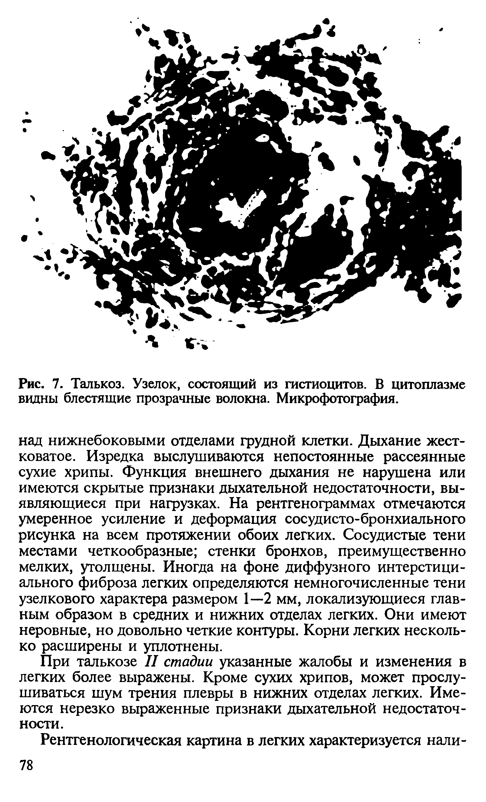 Рис. 7. Талькоз. Узелок, состоящий из гистиоцитов. В цитоплазме видны блестящие прозрачные волокна. Микрофотография.