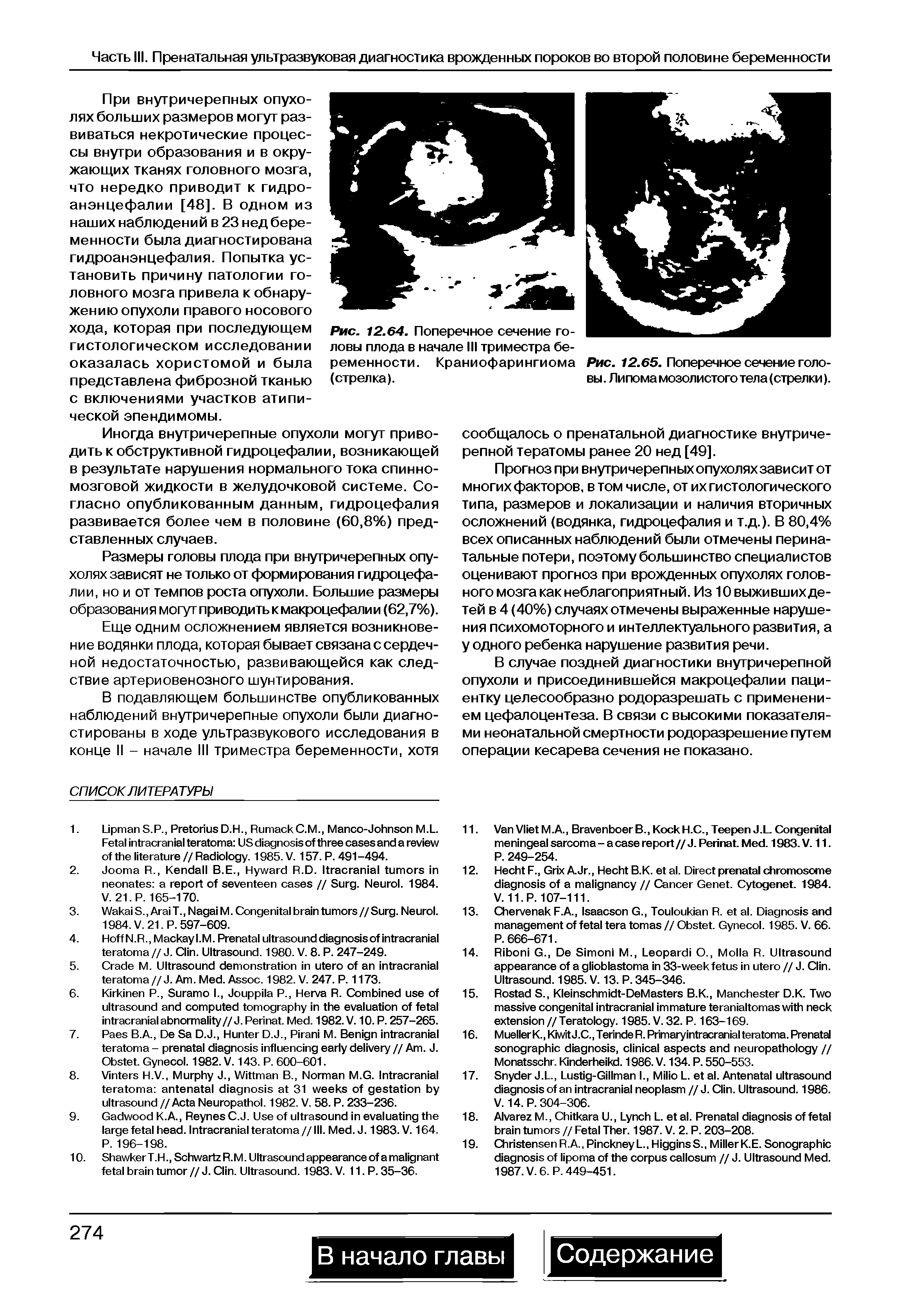 Рис. 12.65. Поперечное сечение головы. Липома мозолистого тела (стрелки).