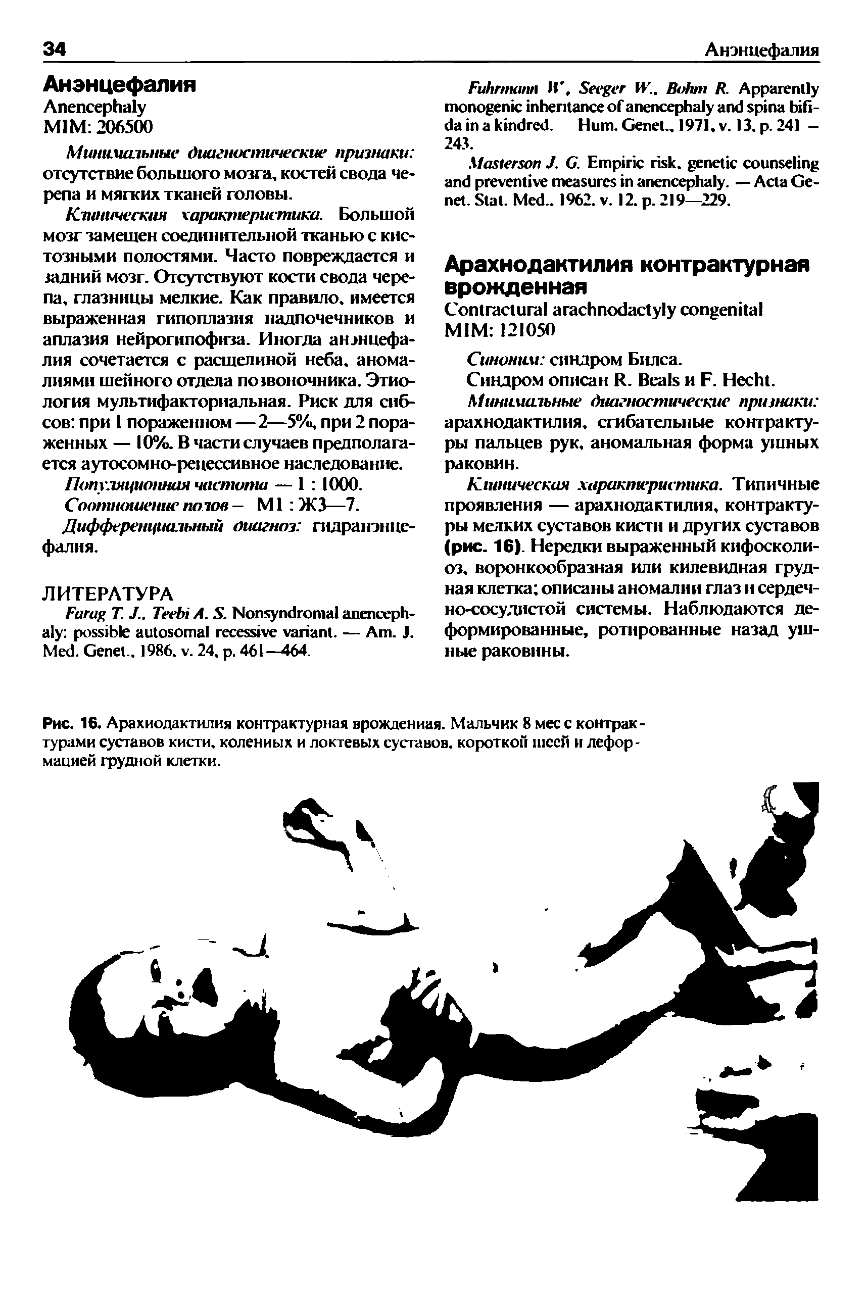 Рис. 16. Арахнодактилия контрактурная врожденная. Мальчик 8 месс контрактурами суставов кисти, коленных и локтевых суставов, короткой шеей и деформацией грудной клетки.