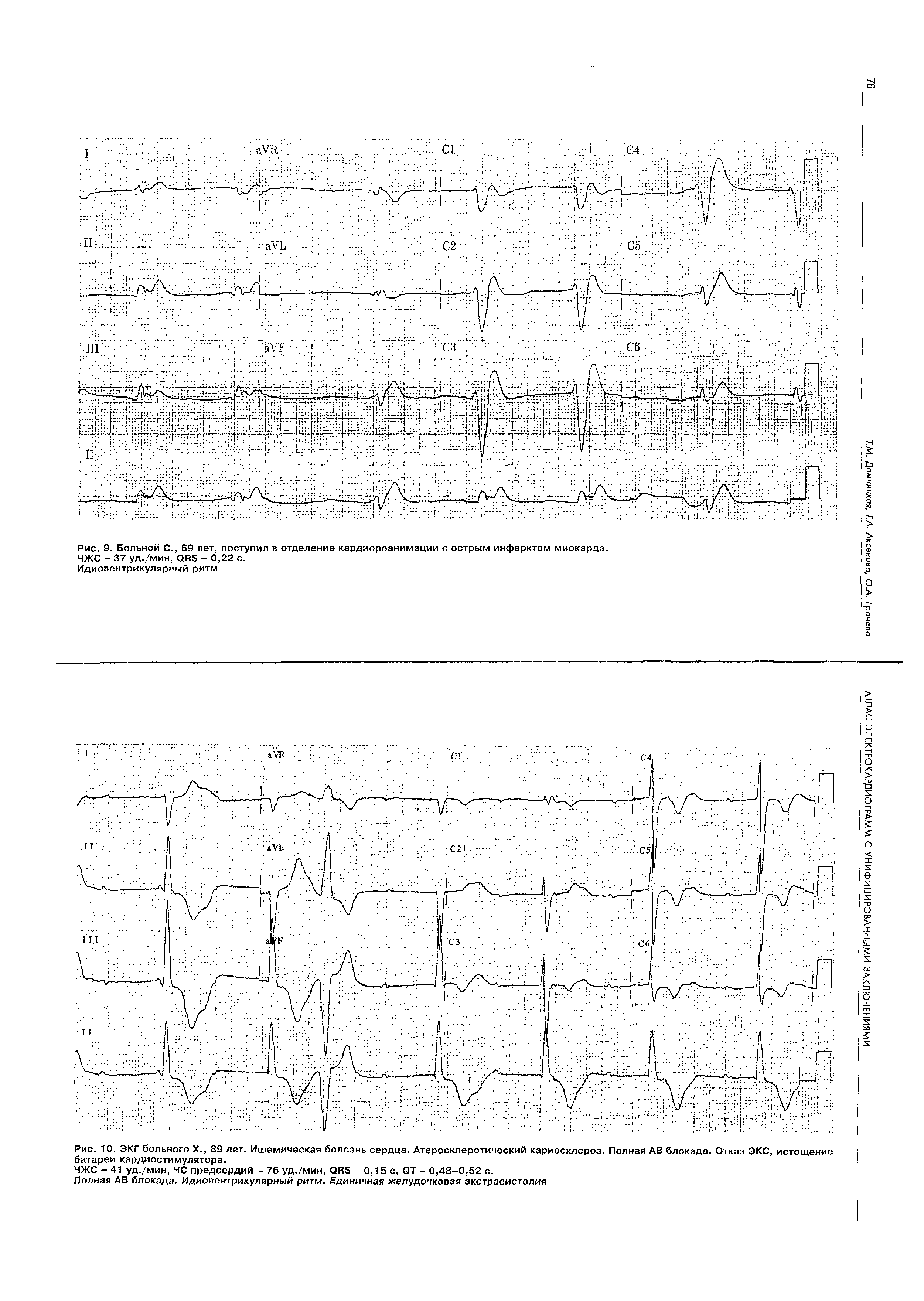 Рис. 10. ЭКГ больного X., 89 лет. Ишемическая болезнь сердца. Атеросклеротический кариосклероз. Полная АВ блокада. Отказ ЭКС, истощение батареи кардиостимулятора.