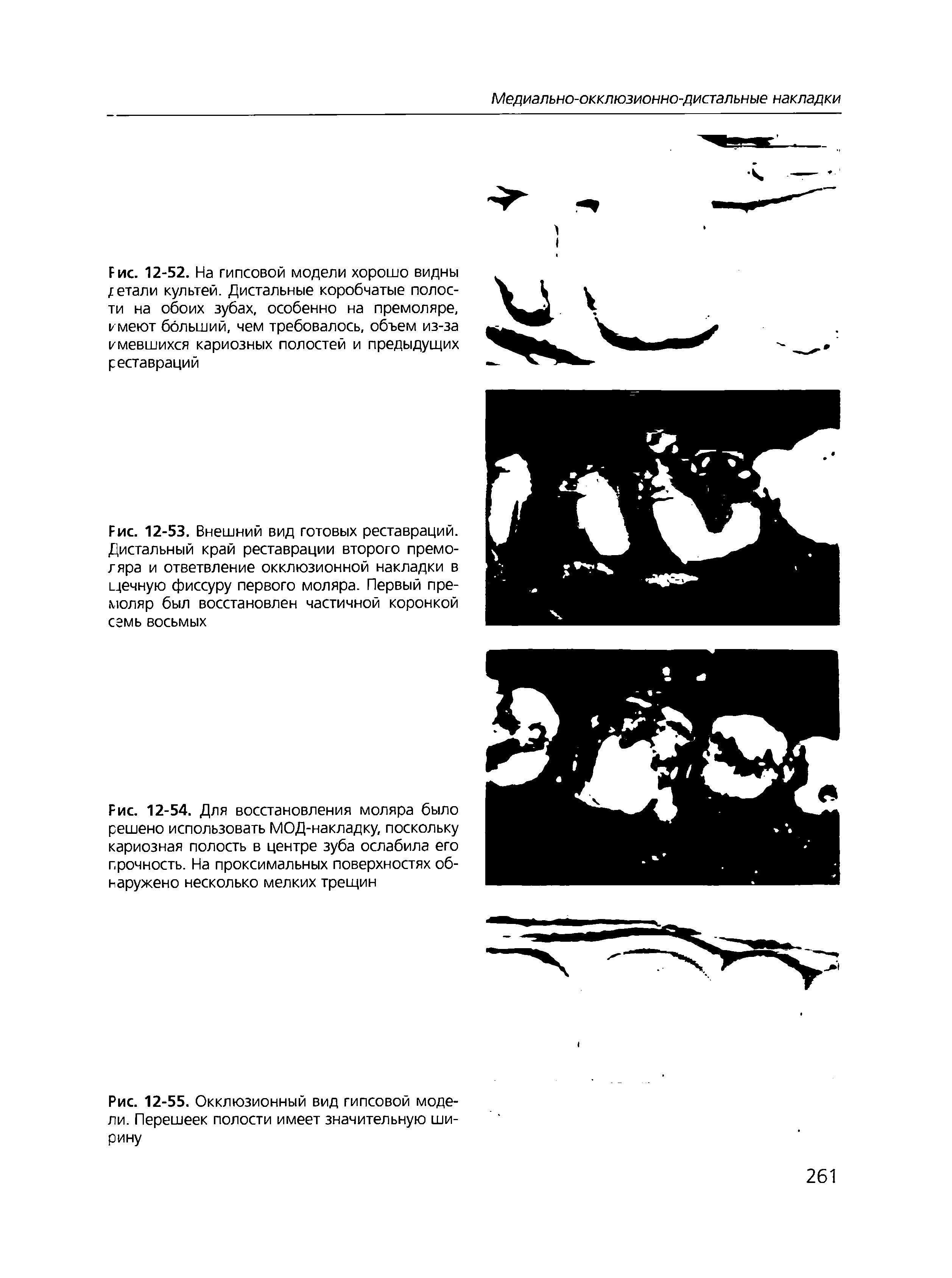Рис. 12-53. Внешний вид готовых реставраций. Дистальный край реставрации второго премоляра и ответвление окклюзионной накладки в щечную фиссуру первого моляра. Первый премоляр был восстановлен частичной коронкой семь восьмых...