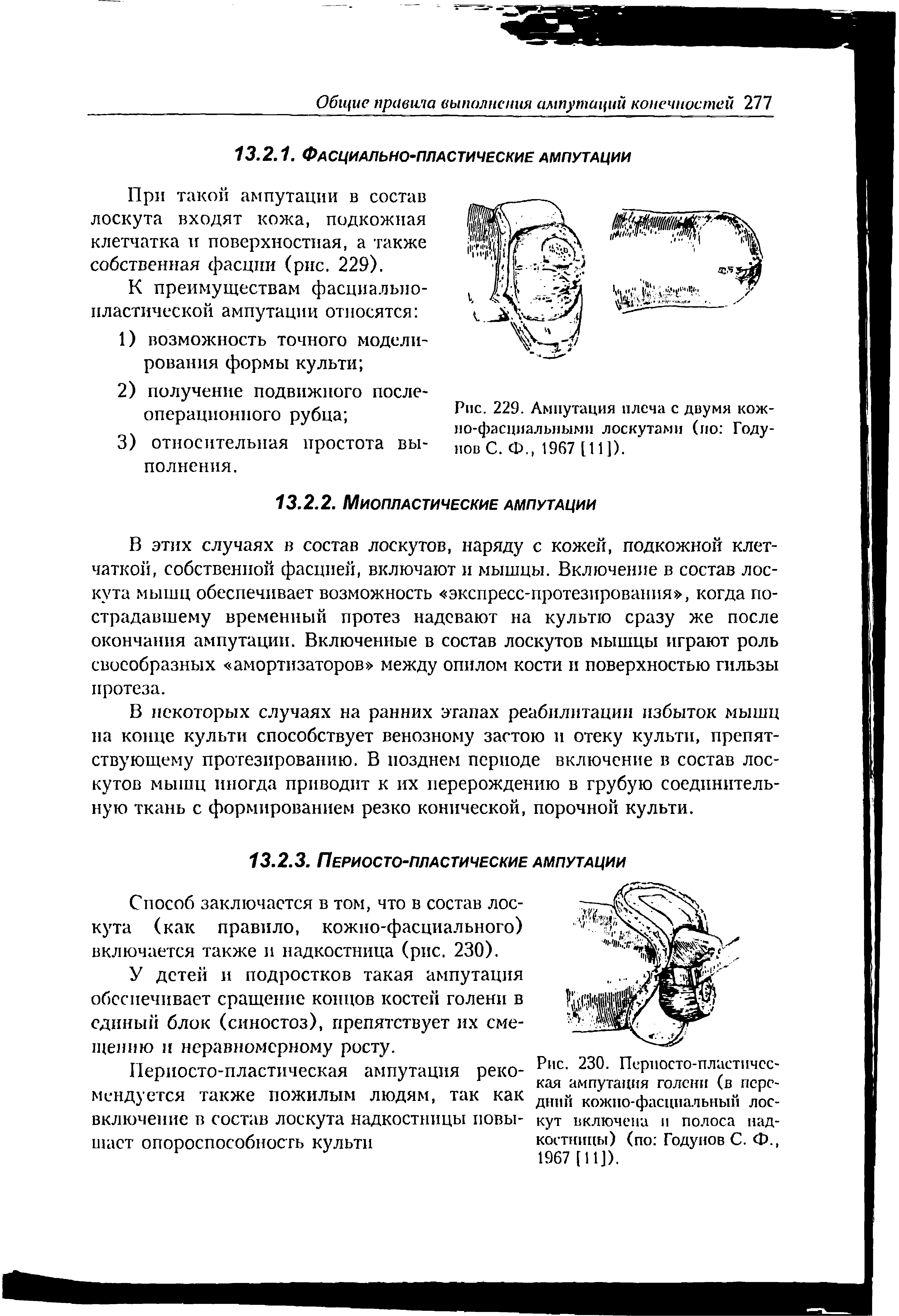 Рис. 230. Периосто-пластическая ампутация голени (в передний кожно-фасциальный лоскут включена и полоса надкостницы) (по Годунов С. Ф., 1967 [И]).