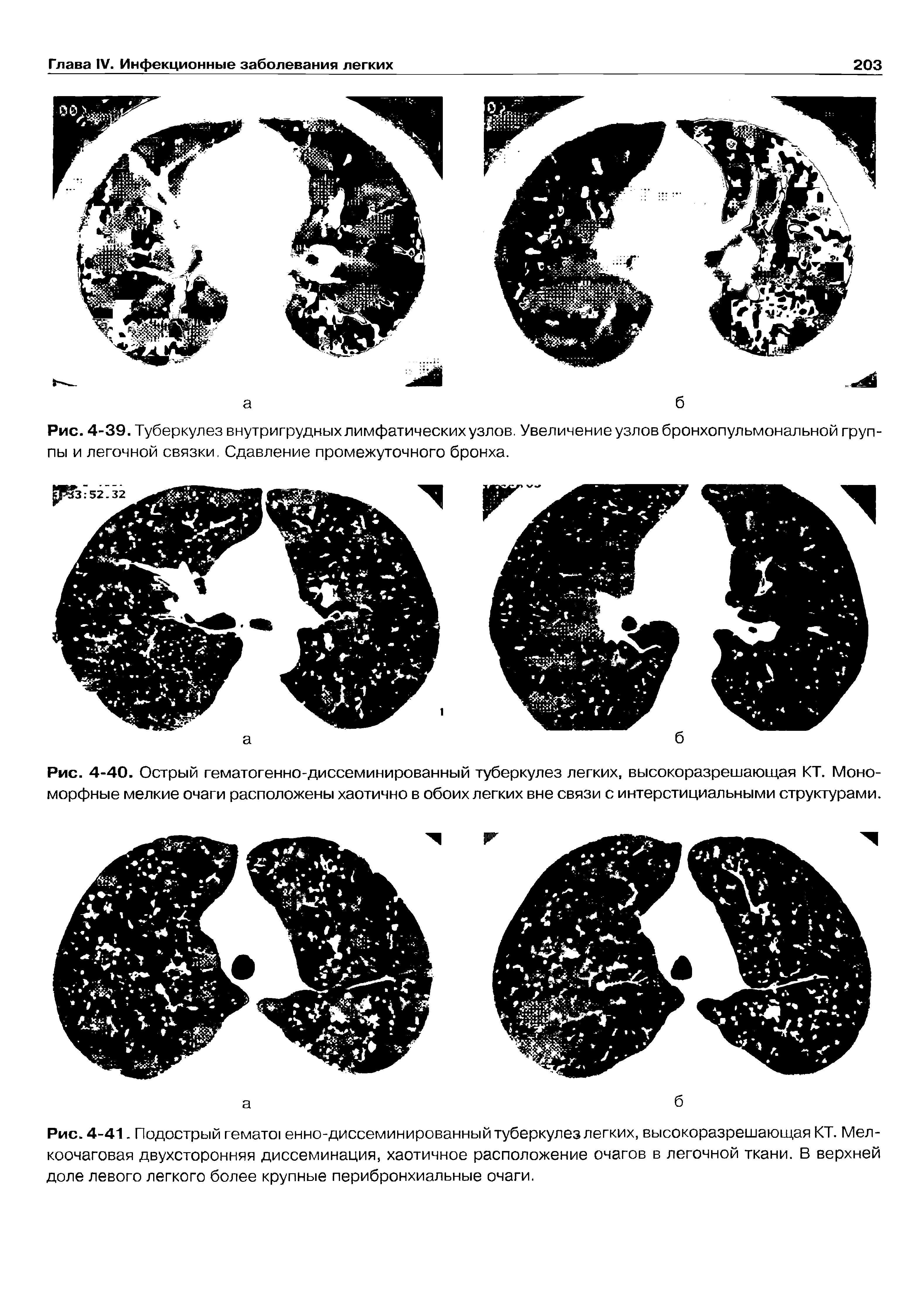 Рис. 4-41. Подострый гемато енно-диссеминированный туберкулез легких, высокоразрешающая КТ. Мелкоочаговая двухсторонняя диссеминация, хаотичное расположение очагов в легочной ткани. В верхней доле левого легкого более крупные перибронхиальные очаги.