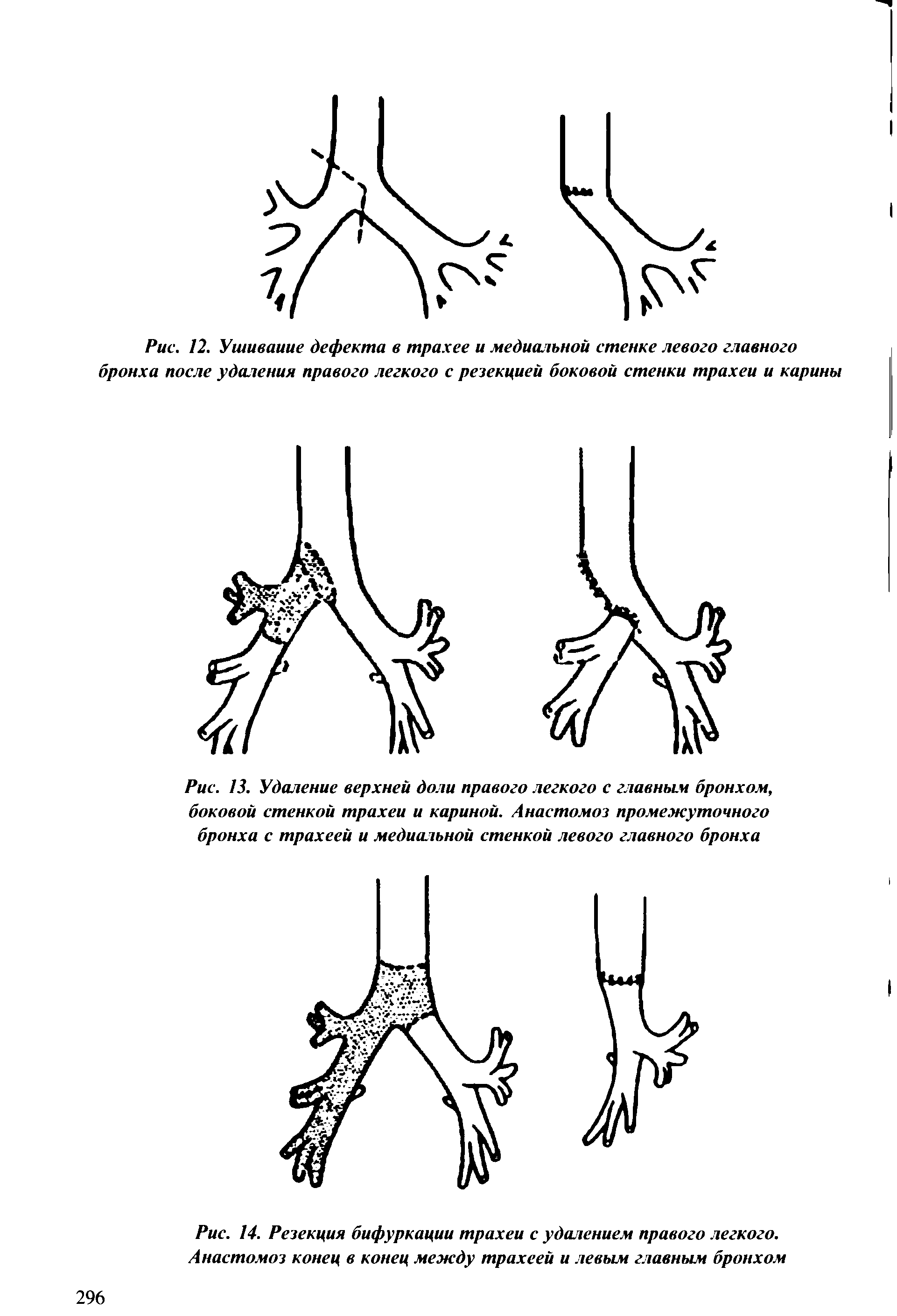Рис. 14. Резекция бифуркации трахеи с удалением правого легкого. Анастомоз конец в конец между трахеей и левым главным бронхом...