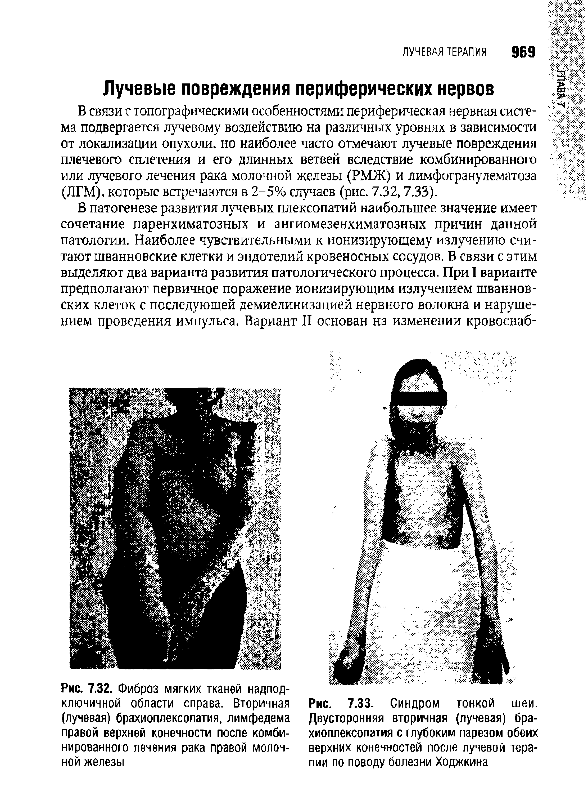 Рис. 7.33. Синдром тонкой шеи. Двусторонняя вторичная (лучевая) брахиоплексопатия с глубоким парезом обеих верхних конечностей после лучевой терапии по поводу болезни Ходжкина...