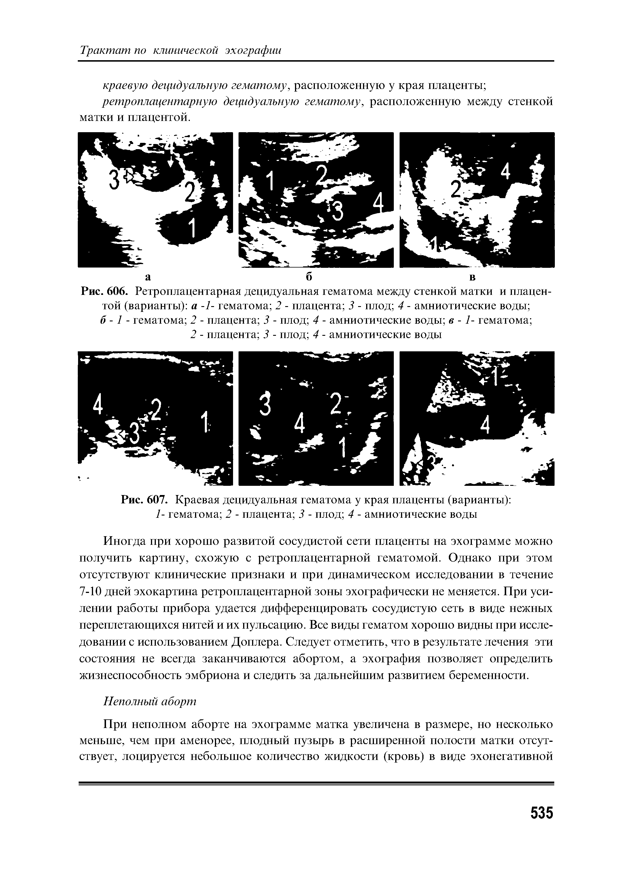 Рис. 606. Ретроплацентарная децидуальная гематома между стенкой матки и плацентой (варианты) а -1- гематома 2 - плацента 3 - плод 4 - амниотические воды б -1 - гематома 2 - плацента 3 - плод 4 - амниотические воды в -1- гематома ...