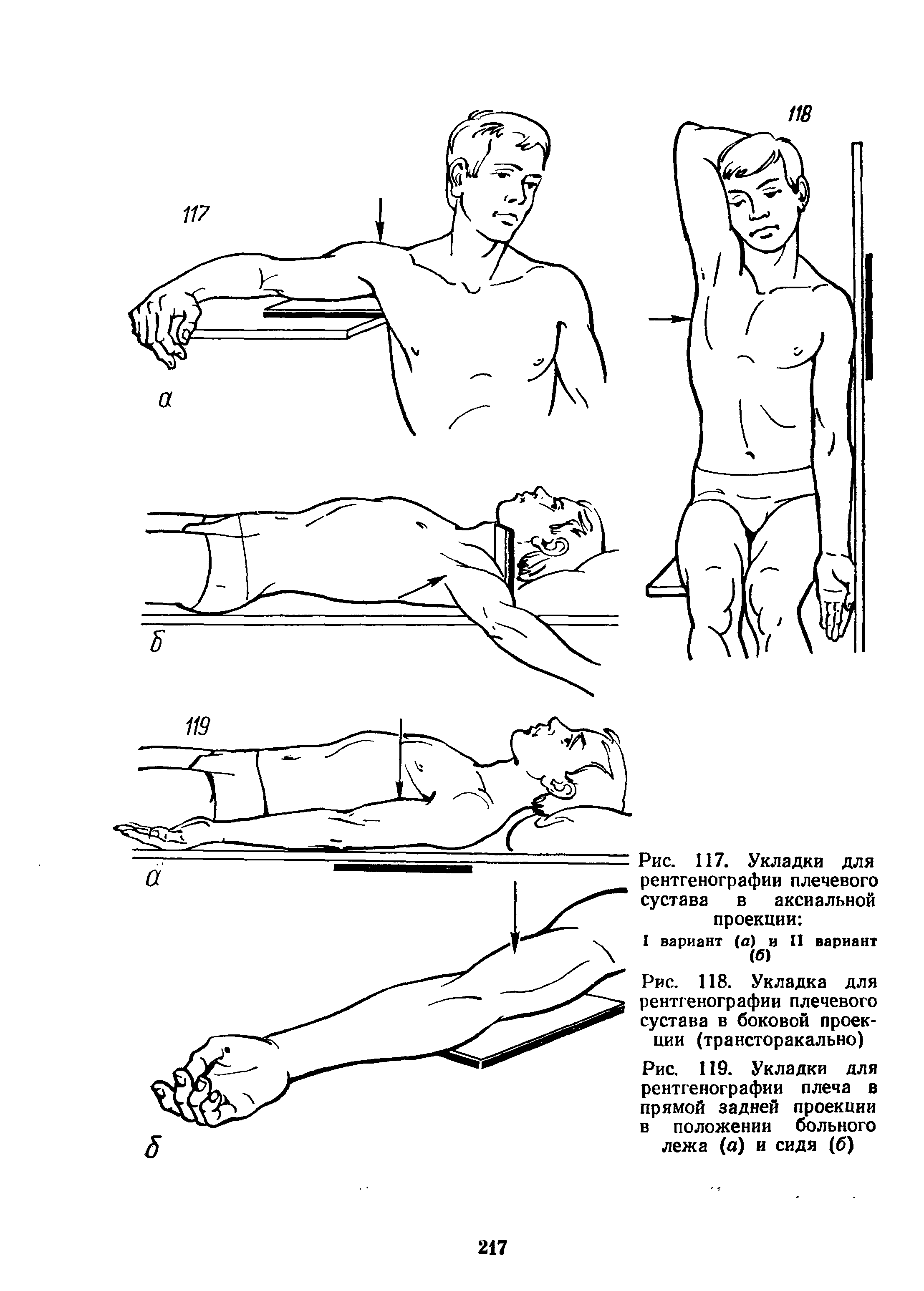 Рис. 119. Укладки для рентгенографии плеча в прямой задней проекции в положении больного лежа (а) и сидя (б)...