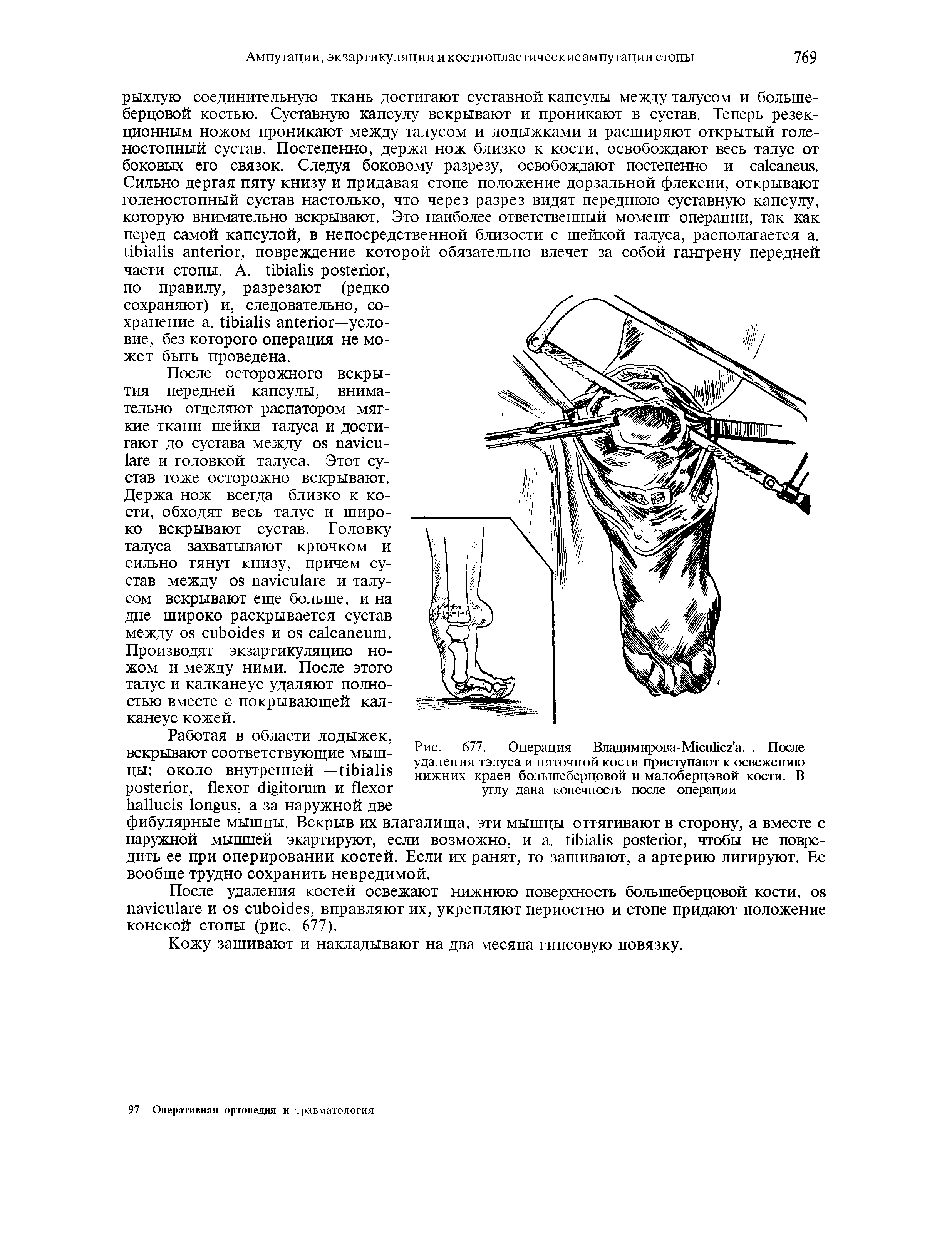 Рис. 677. Операция Владимирова-Мюийсг а.. После удаления тэлуса и пяточной кости приступают к освежению нижних краев большеберцовой и малоберцовой кости. В углу дана конечность после операции...