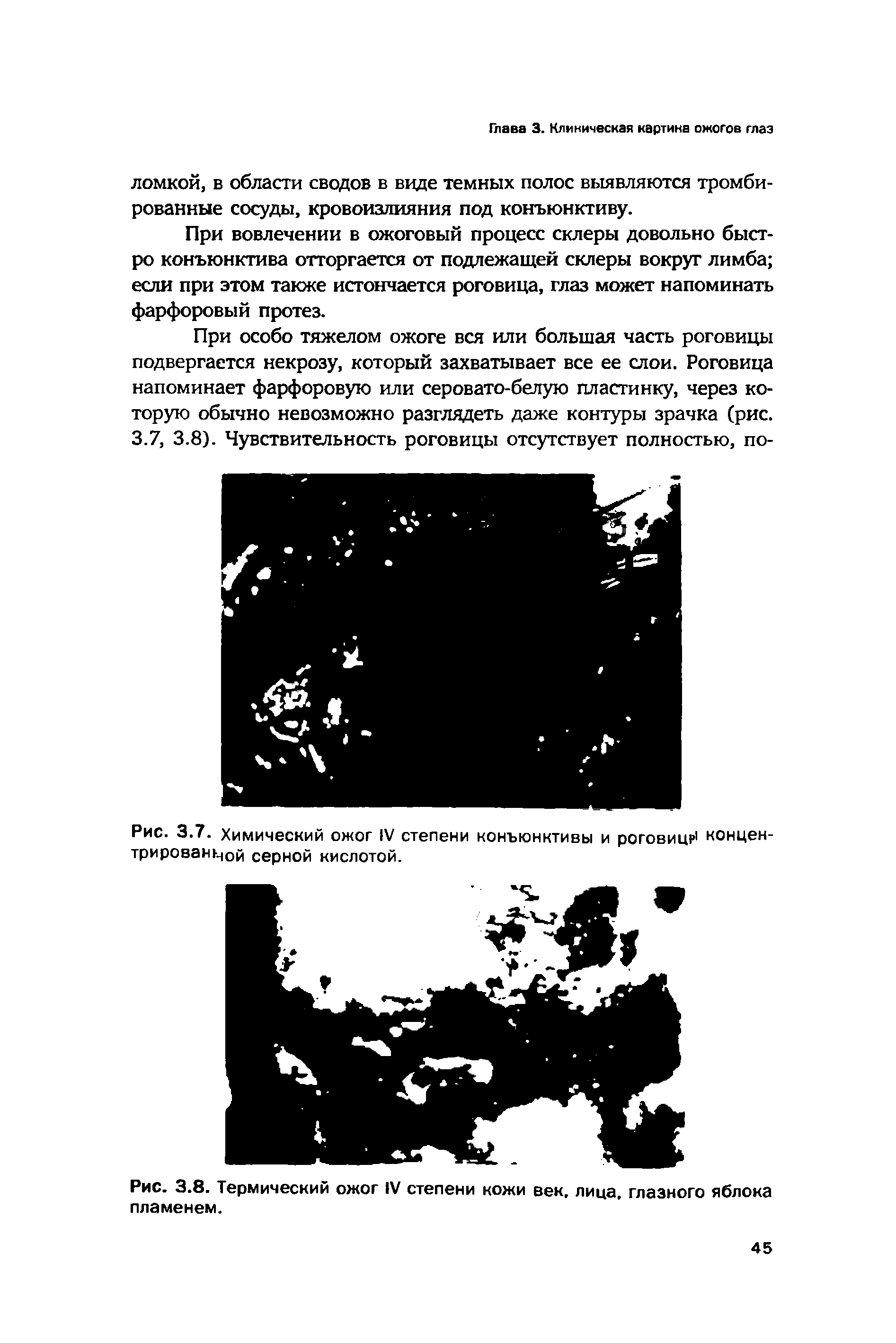 Рис. 3.7. Химический ожог IV степени конъюнктивы и роговиц концентрированной серной кислотой.