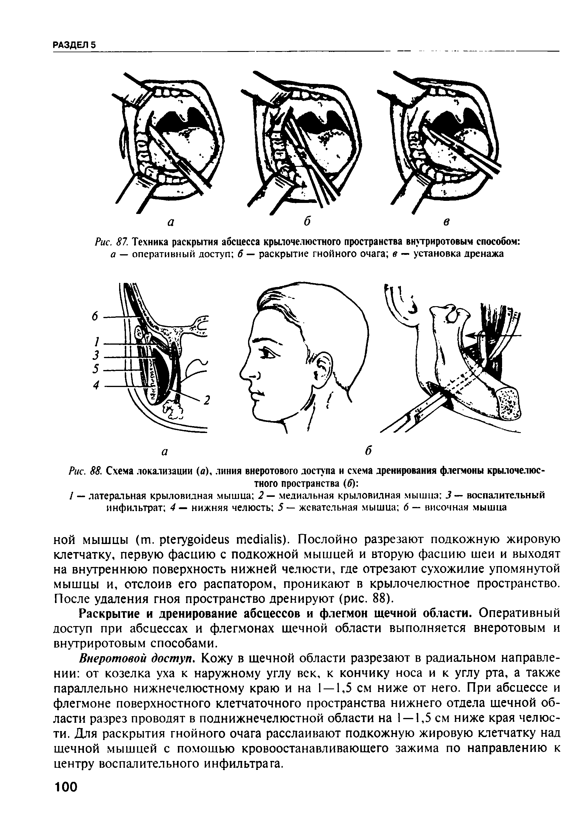 Рис. 88. Схема локализации (о), линия внеротового доступа и схема дренирования флегмоны крылочелюстного пространства (б) ...