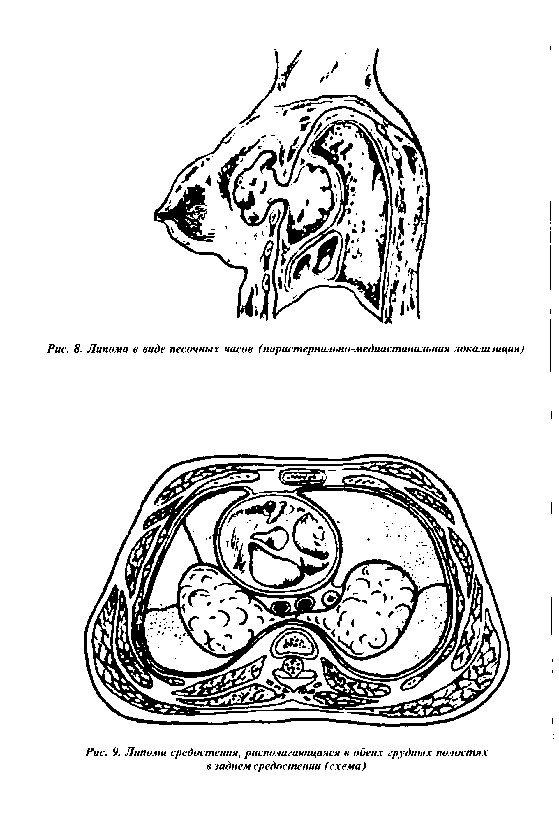 Рис. 9. Липома средостения, располагающаяся в обеих грудных полостях в заднем средостении (схема)...