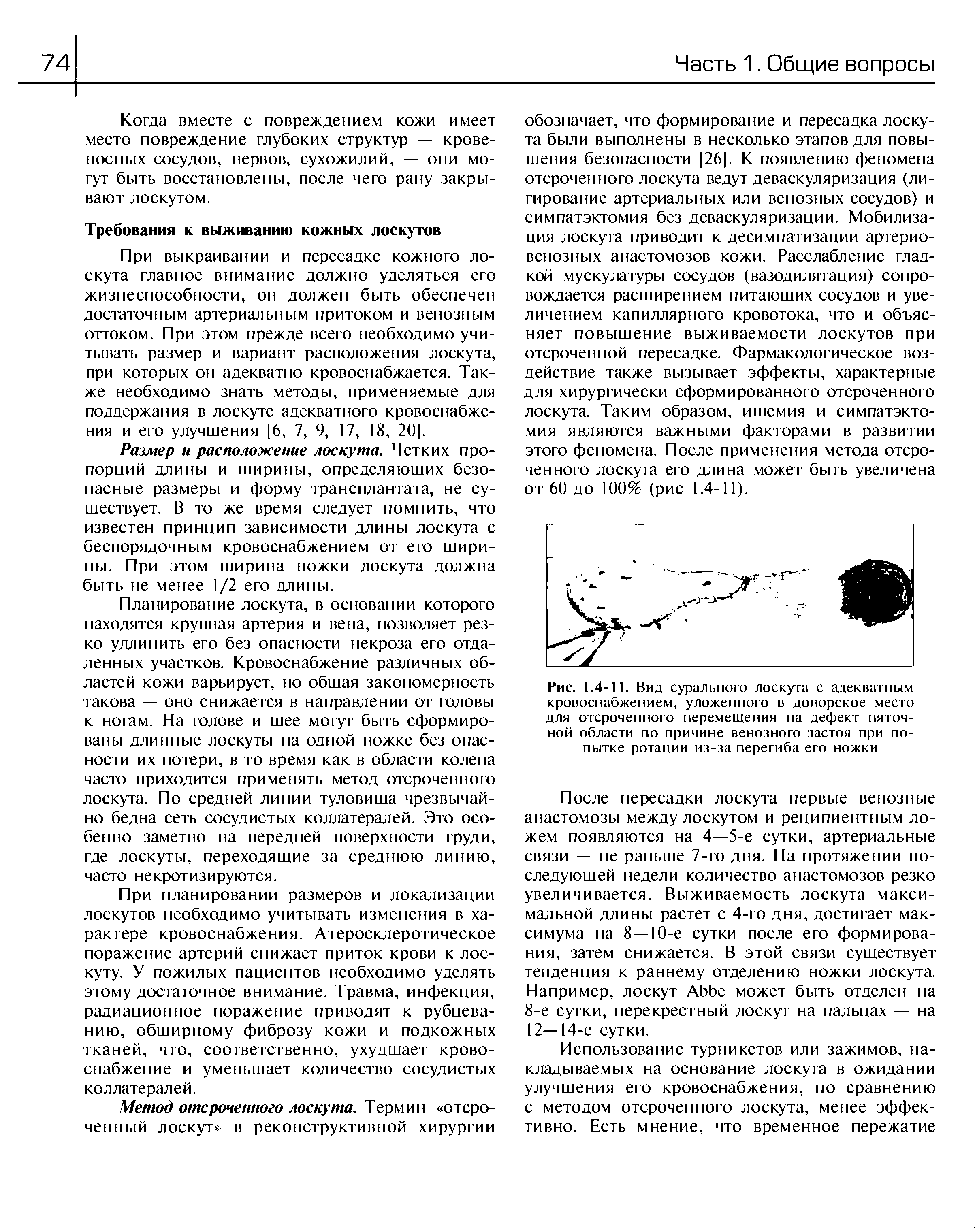 Рис. 1.4-11. Вид сурального лоскута с адекватным кровоснабжением, уложенного в донорское место для отсроченного перемещения на дефект пяточной области по причине венозного застоя при попытке ротации из-за перегиба его ножки...