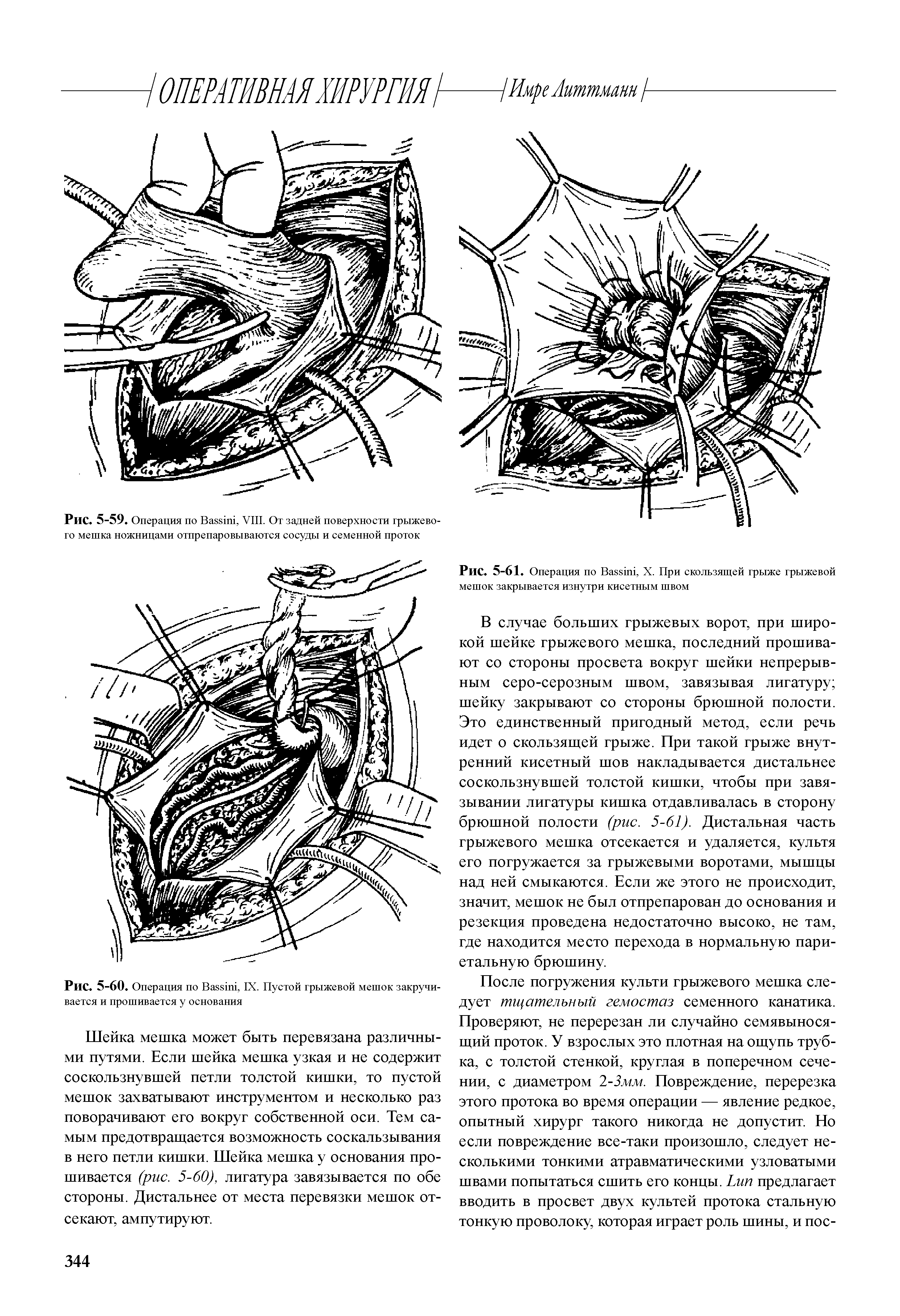 Рис. 5-61. Операция по B , X. При скользящей грыже грыжевой мешок закрывается изнутри кисетным швом...