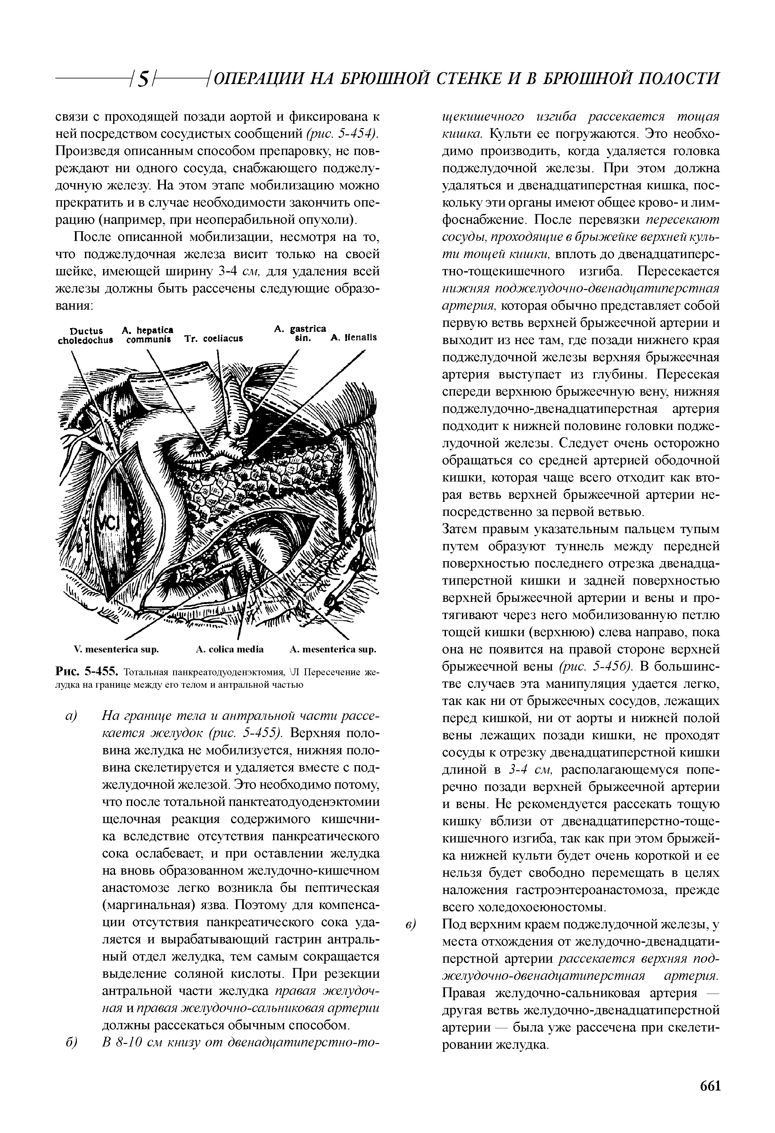 Рис. 5-455. Тотальная панкреатодуоденэктомия, Л Пересечение желудка на границе между его телом и антральной частью...