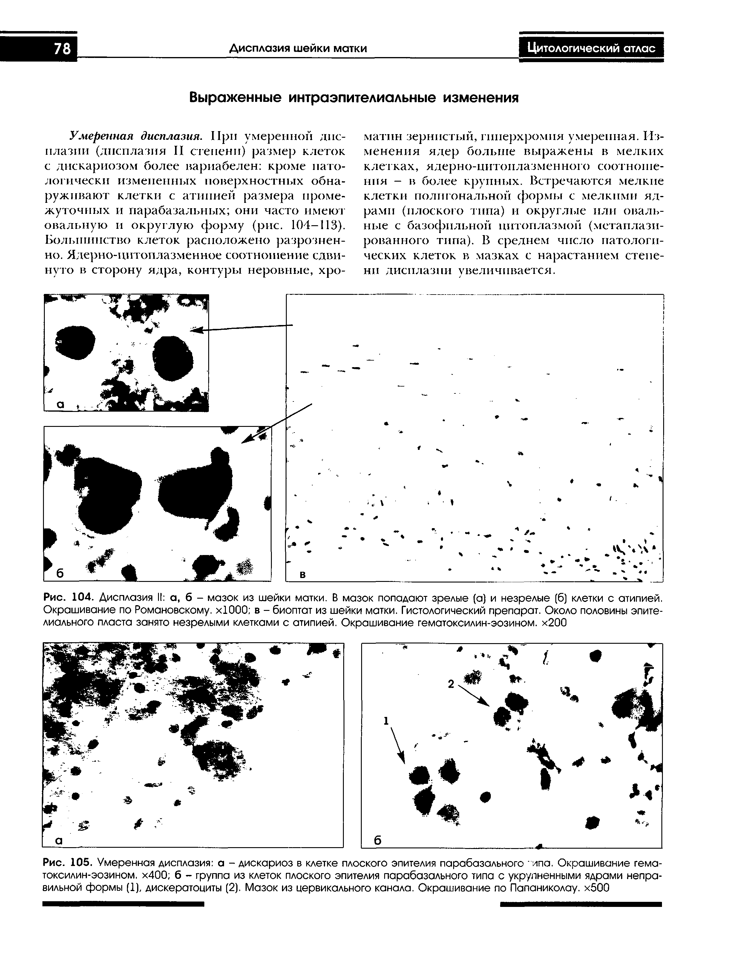 Рис. 104. Дисплазия II а, б - мазок из шейки матки. В мазок попадают зрелые (а) и незрелые (6) клетки с атипией. Окрашивание по Романовскому. хЮОО в - биоптат из шейки матки. Гистологический препарат. Около половины эпителиального пласта занято незрелыми клетками с атипией. Окрашивание гематоксилин-эозином. х200...