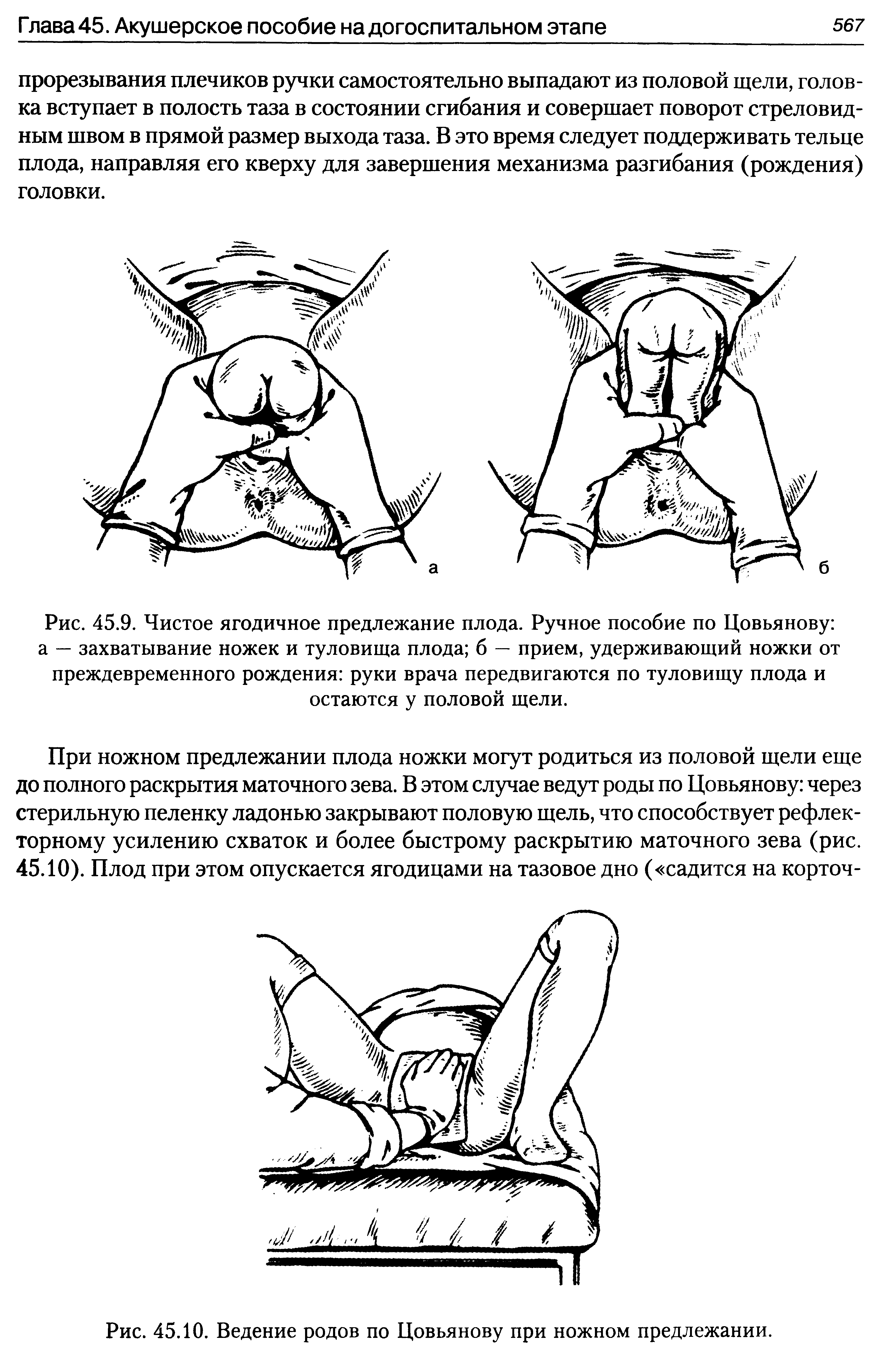 Рис. 45.9. Чистое ягодичное предлежание плода. Ручное пособие по Цовьянову а — захватывание ножек и туловища плода б — прием, удерживающий ножки от преждевременного рождения руки врача передвигаются по туловищу плода и остаются у половой щели.