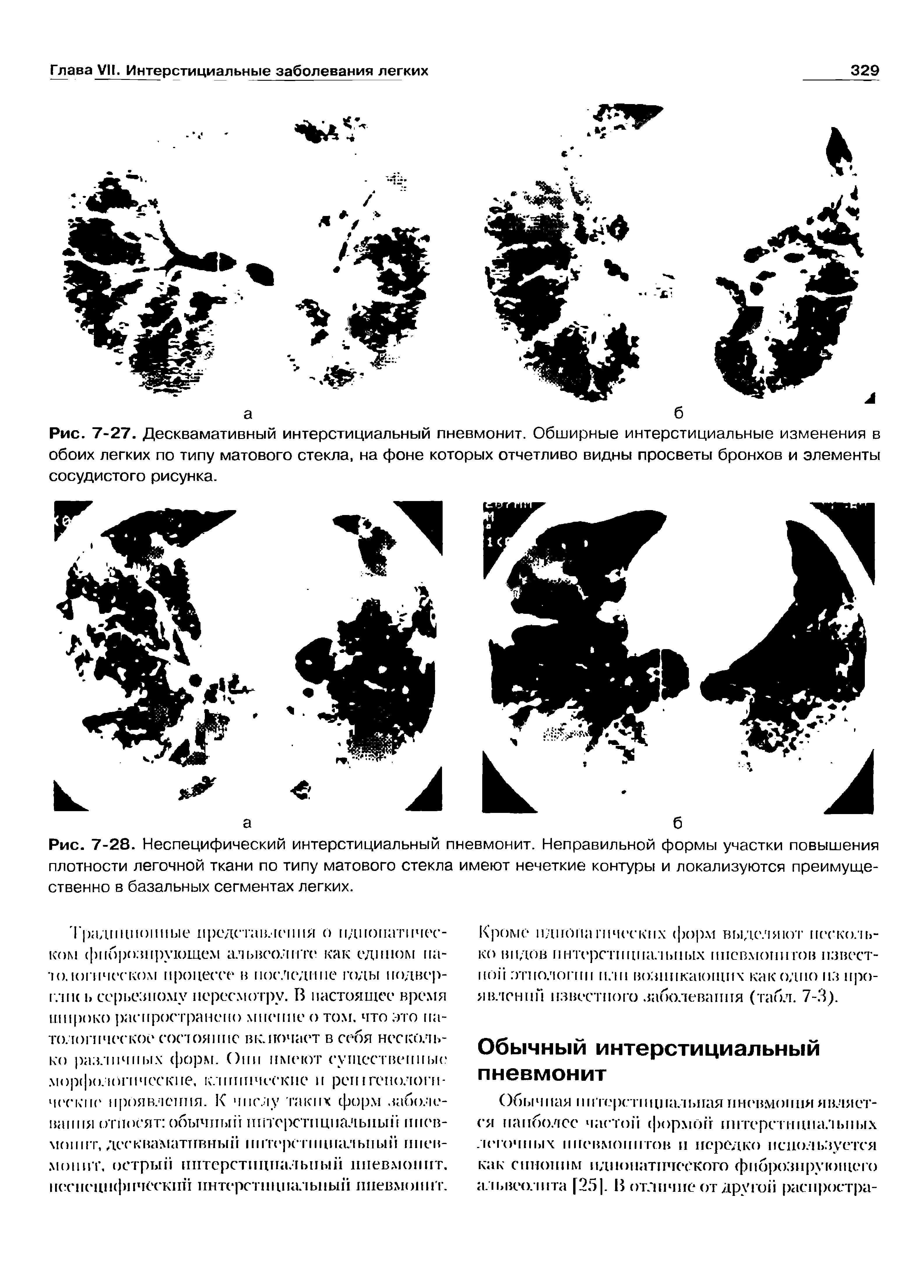 Рис. 7-27. Десквамативный интерстициальный пневмонит. Обширные интерстициальные изменения в обоих легких по типу матового стекла, на фоне которых отчетливо видны просветы бронхов и элементы сосудистого рисунка.