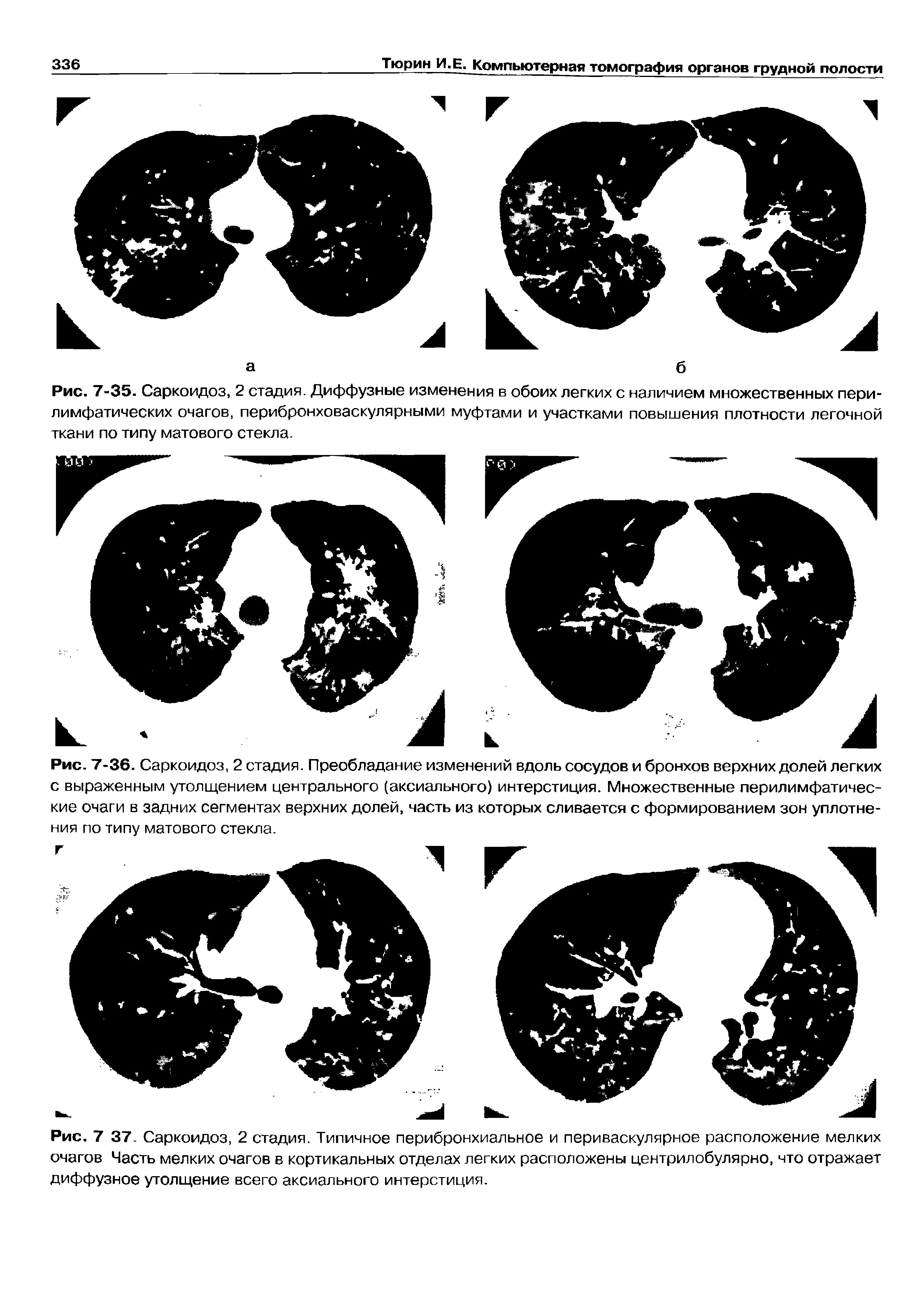 Рис. 7 37. Саркоидоз, 2 стадия. Типичное перибронхиальное и периваскулярное расположение мелких очагов Часть мелких очагов в кортикальных отделах легких расположены центрилобулярно, что отражает диффузное утолщение всего аксиального интерстиция.