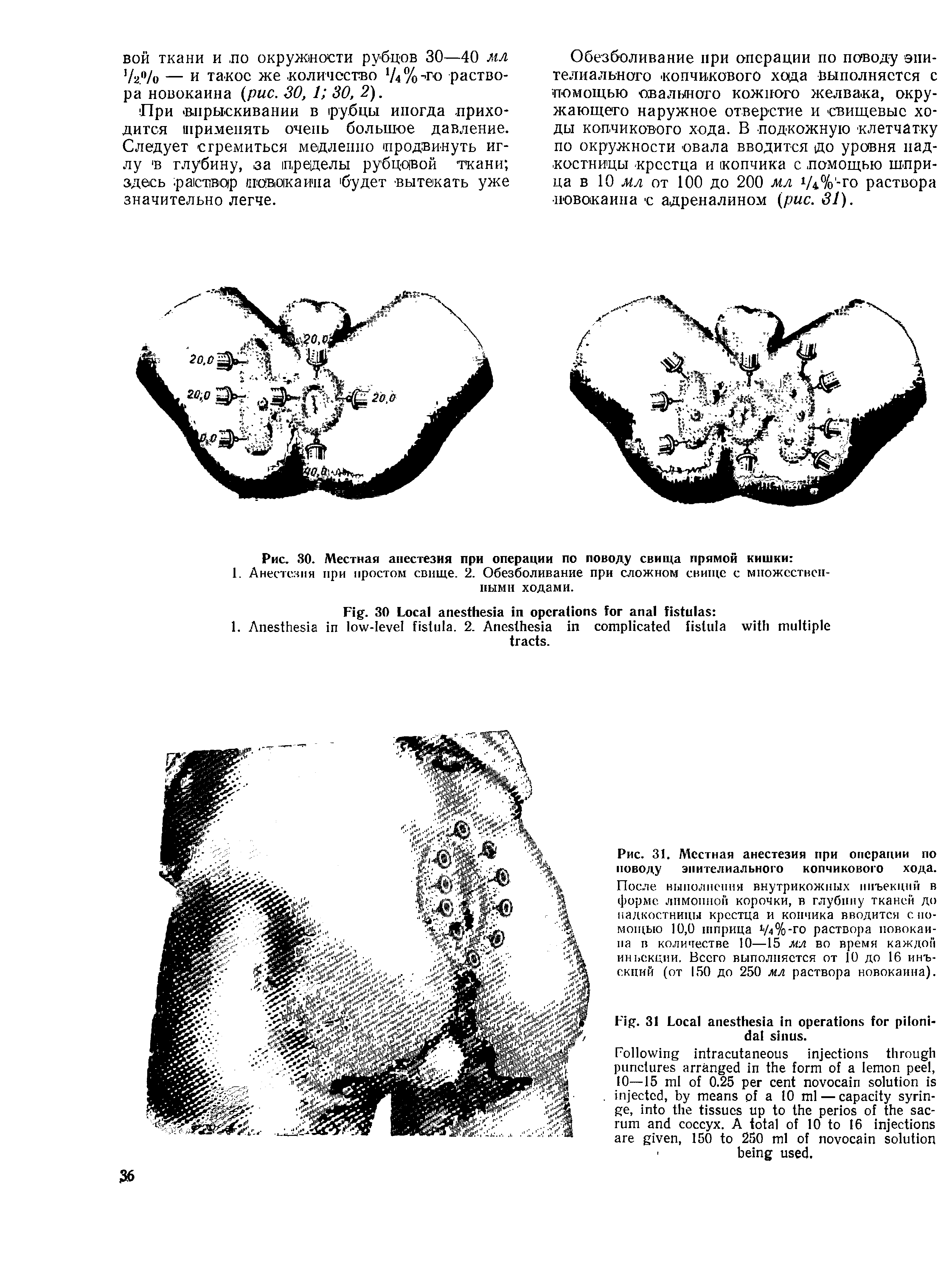 Рис. 30. Местная анестезия при операции по поводу свища прямой кишки ...