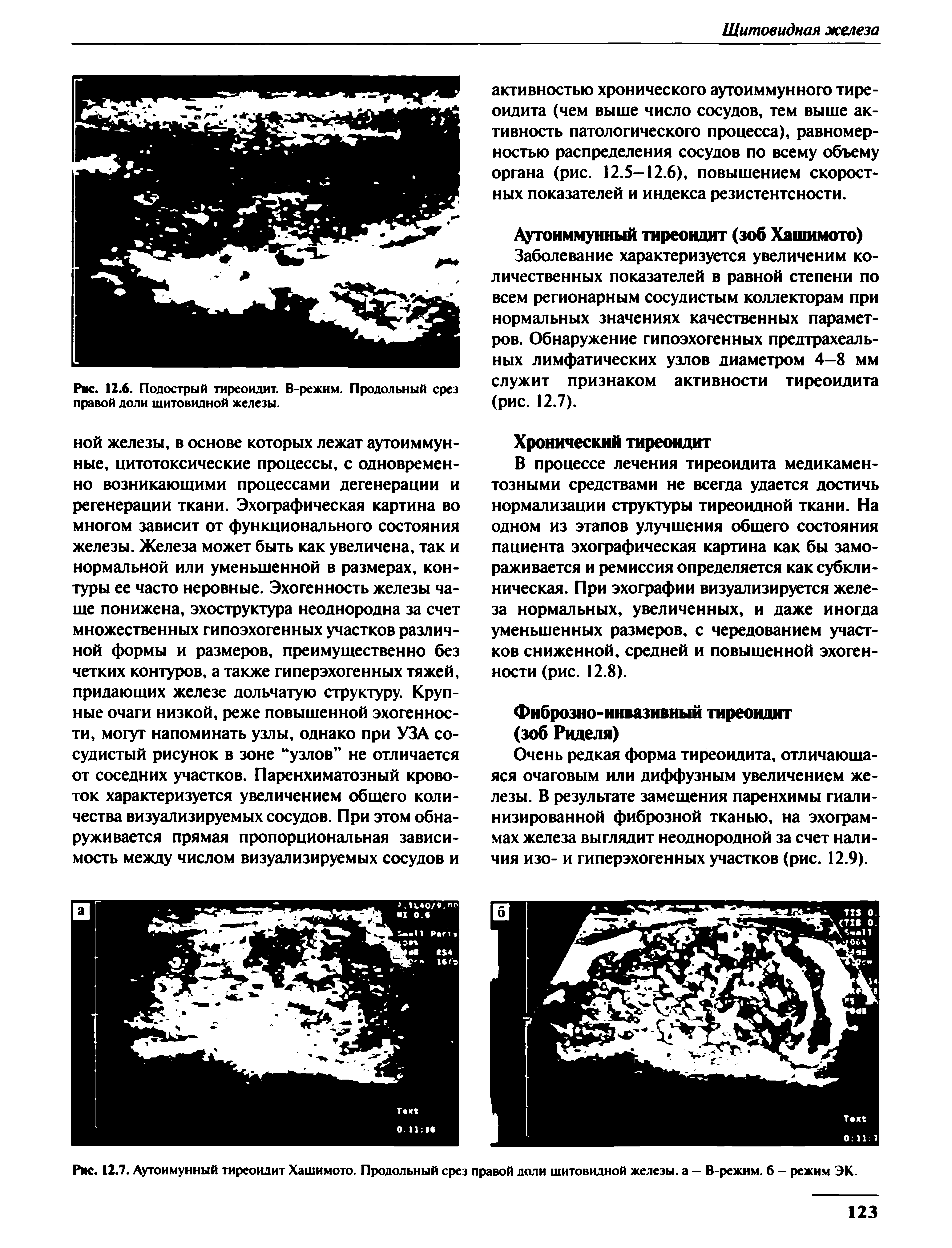 Рис. 12.7. Аутоимунный тиреоидит Хашимото. Продольный срез правой доли шитовидной железы, а — В-режим. б — режим ЭК.