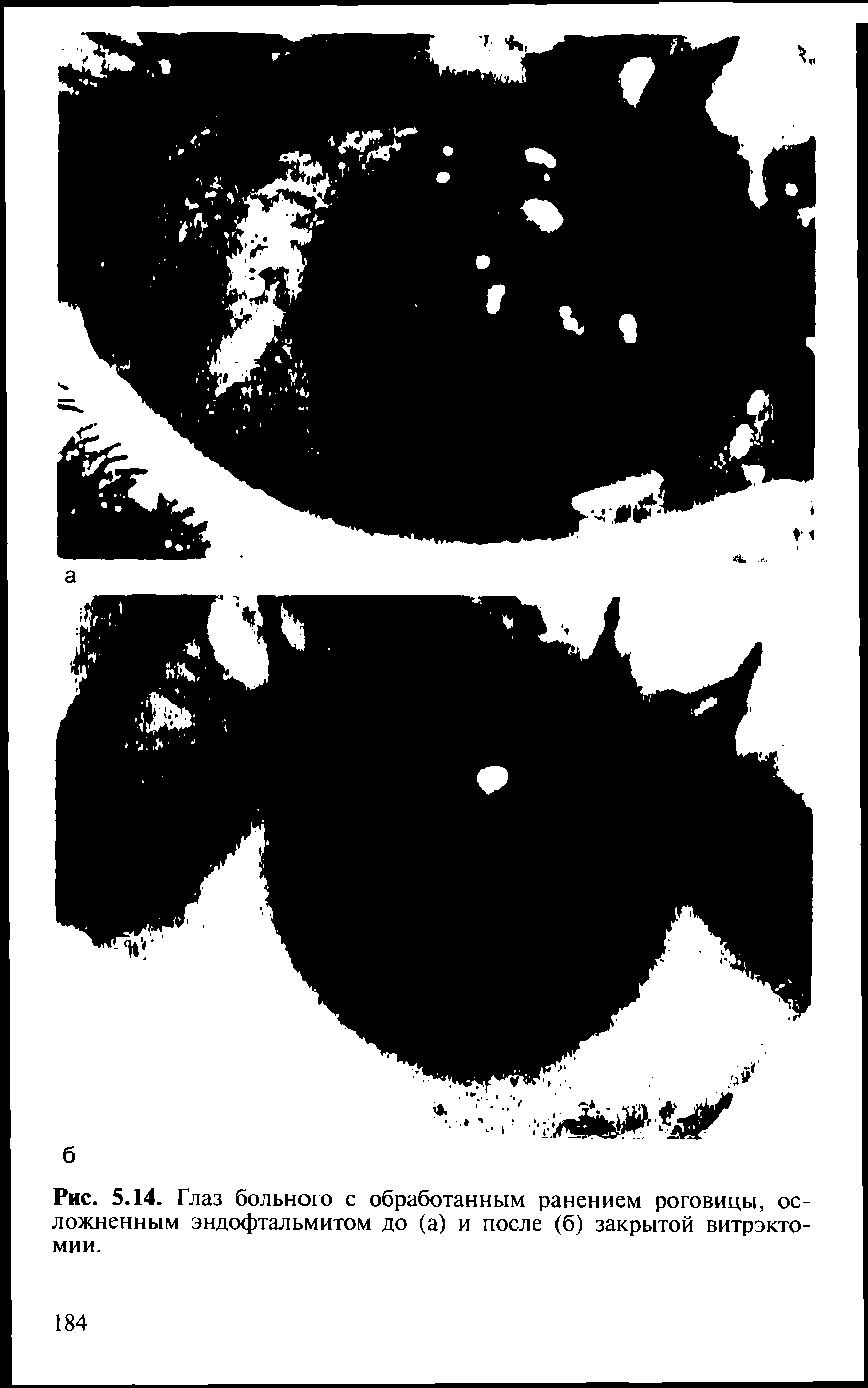 Рис. 5.14. Глаз больного с обработанным ранением роговицы, осложненным эндофтальмитом до (а) и после (б) закрытой витрэктомии.
