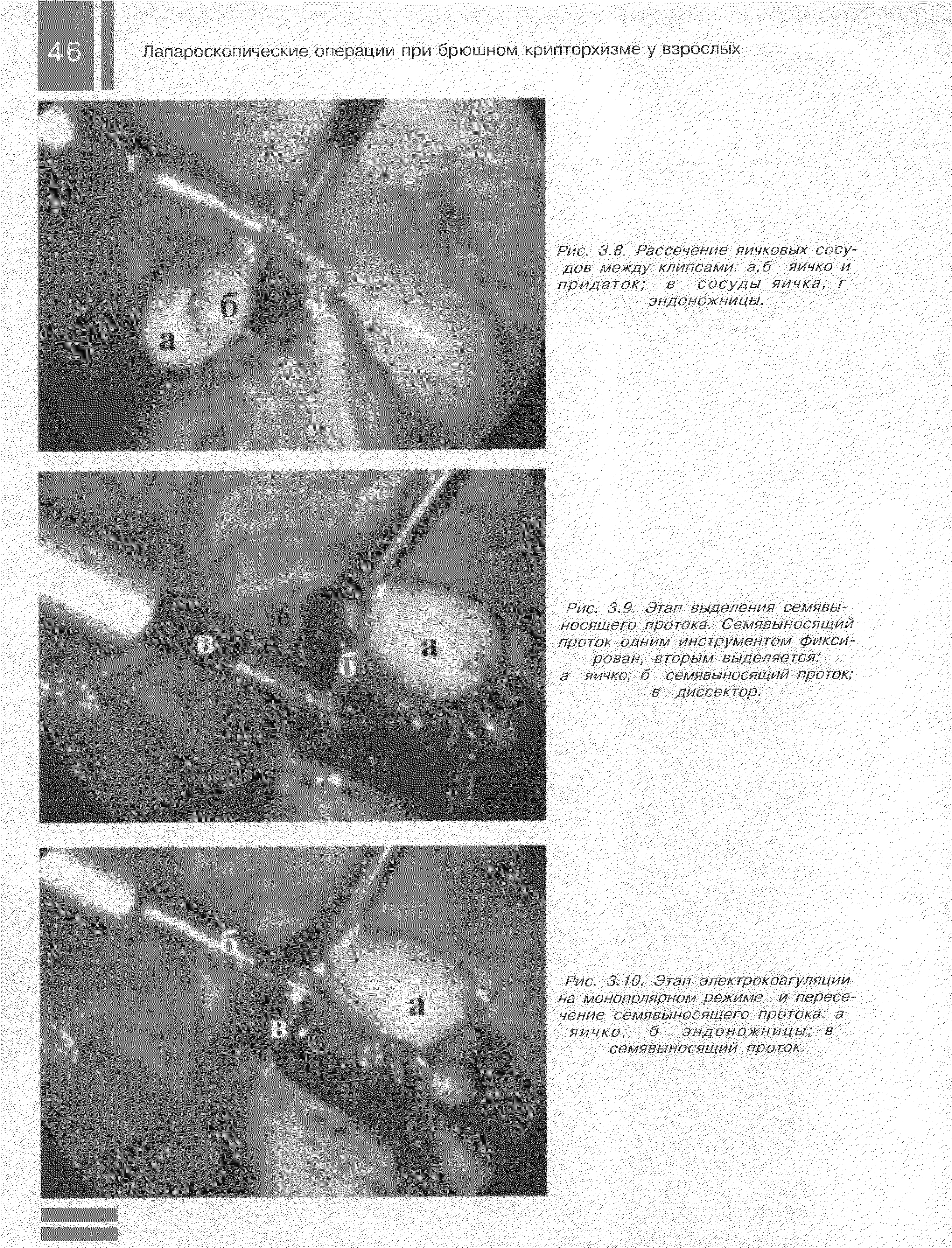 Рис. 3.8. Рассечение яичковых сосу дов между клипсами а, б яичко и придаток в сосуды яичка г эндоножницы.