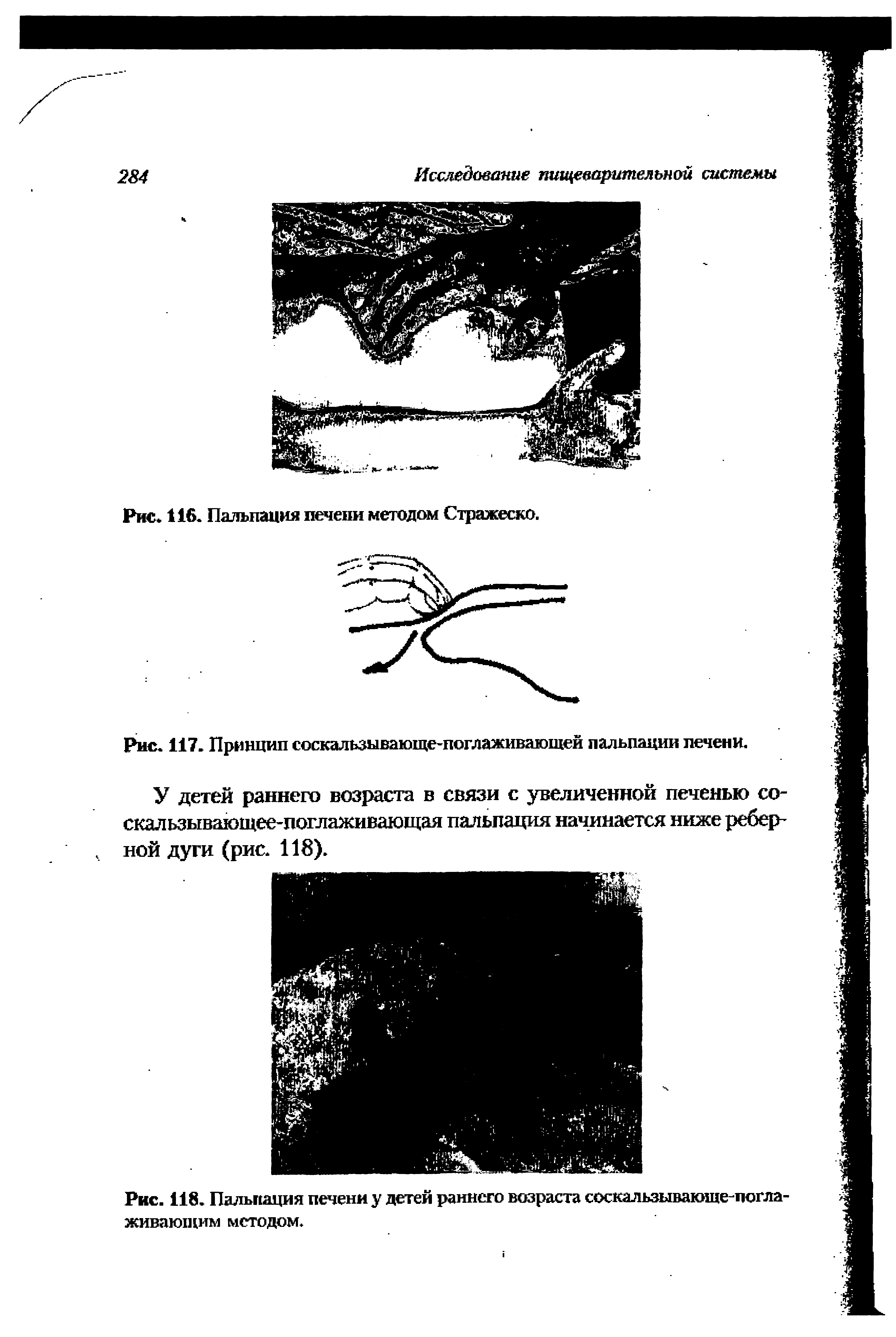 Рис. 118. Пальпация печени у детей раннего возраста соскальзывающе-погла-живающим методом.