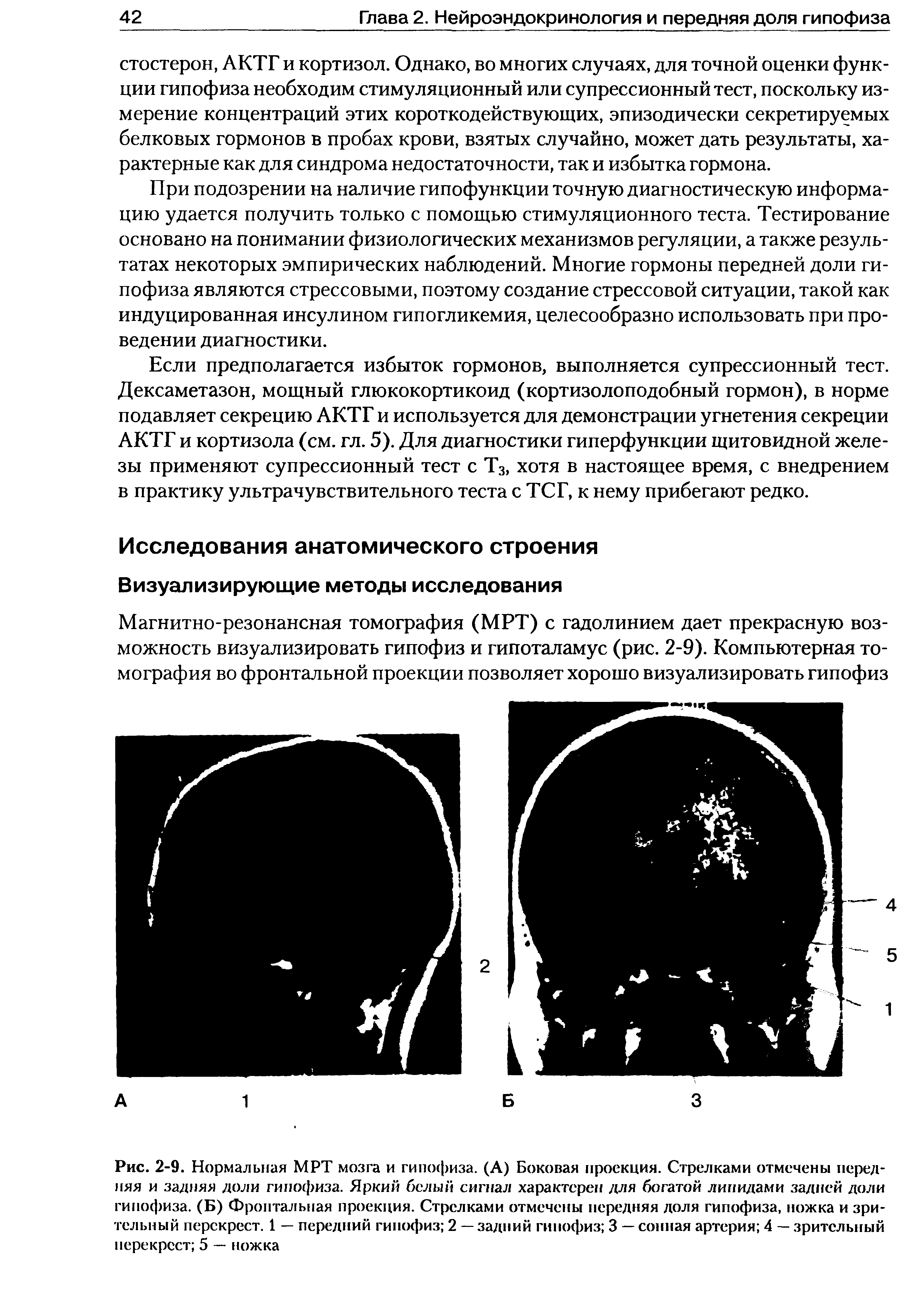 Рис. 2-9. Нормальная МРТ мозга и гипофиза. (А) Боковая проекция. Стрелками отмечены передняя и задняя доли гипофиза. Яркий белый сигнал характерен для богатой липидами задней доли гипофиза. (Б) Фронтальная проекция. Стрелками отмечены передняя доля гипофиза, ножка и зрительный перекрест. 1 — передний гипофиз 2 — задний гипофиз 3 — сонная артерия 4 — зрительный перекрест 5 — ножка...