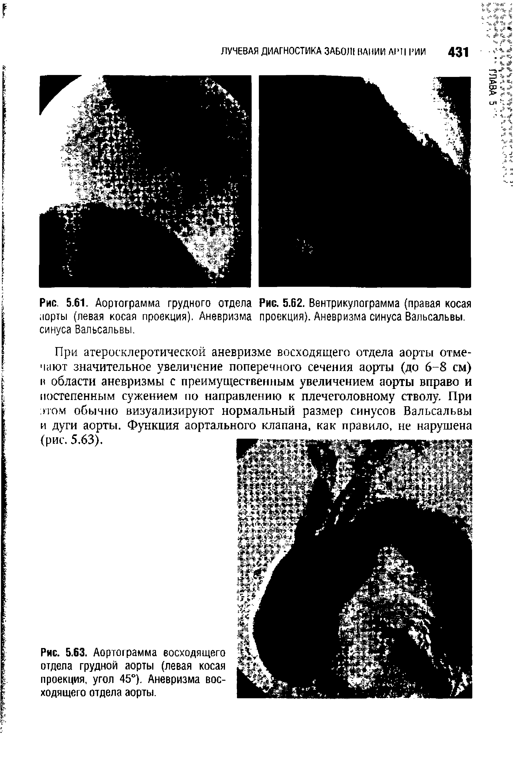 Рис. 5.61. Аортограмма грудного отдела Рис. 5.62. Вентрикулограмма (правая косая аорты (левая косая проекция). Аневризма проекция). Аневризма синуса Вальсальвы, синуса Вальсальвы.
