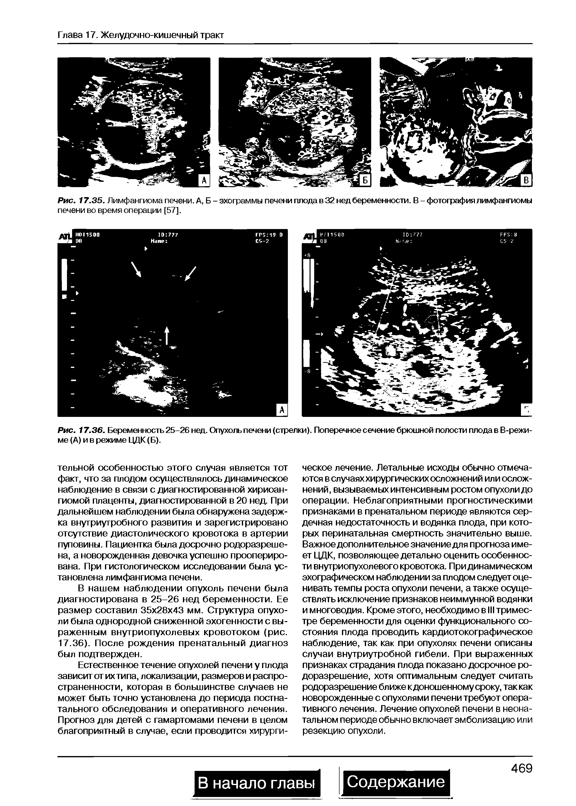 Рис. 17.35. Лимфангиома печени. А, Б - эхограммы печени плода в 32 нед беременности. В-фотография лимфангиомы печени во время операции [57].