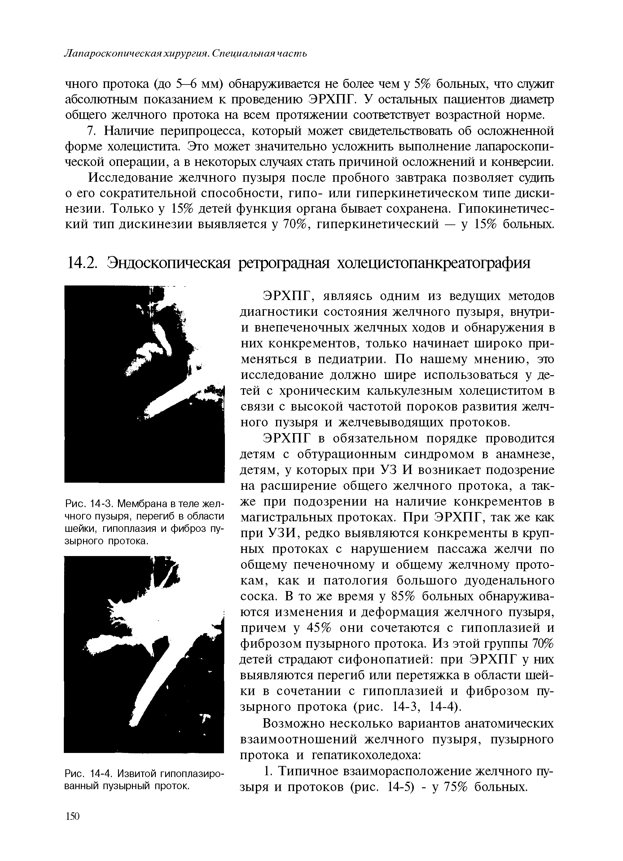 Рис. 14-3. Мембрана в теле желчного пузыря, перегиб в области шейки, гипоплазия и фиброз пузырного протока.