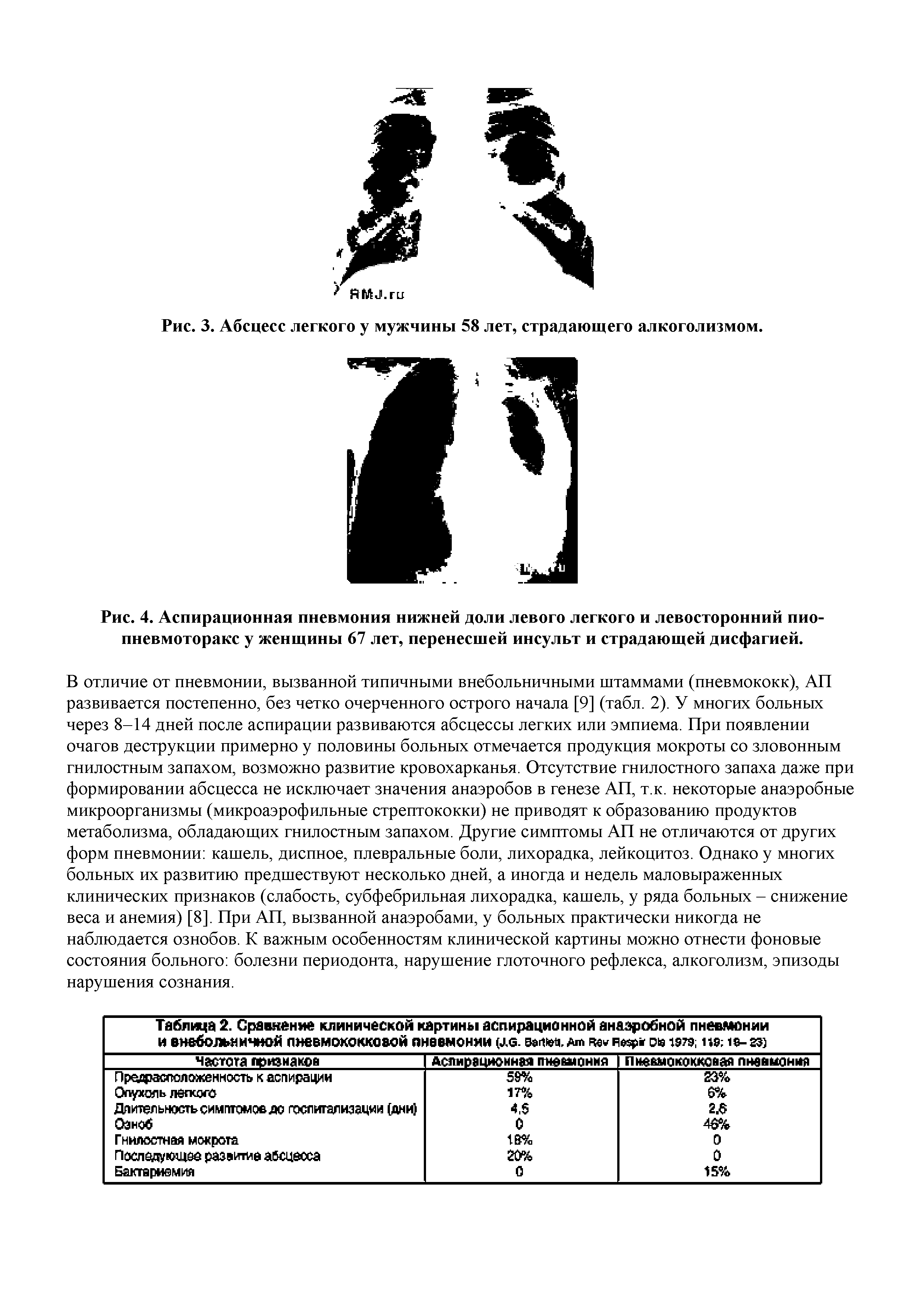 Таблица 2. Сравнение клинической картины аспирационной анаэробной пневмонии и внебольн ичной пневмококковой пневмонии (л,б. валм, аш чв лври ов гэтэ, па ...