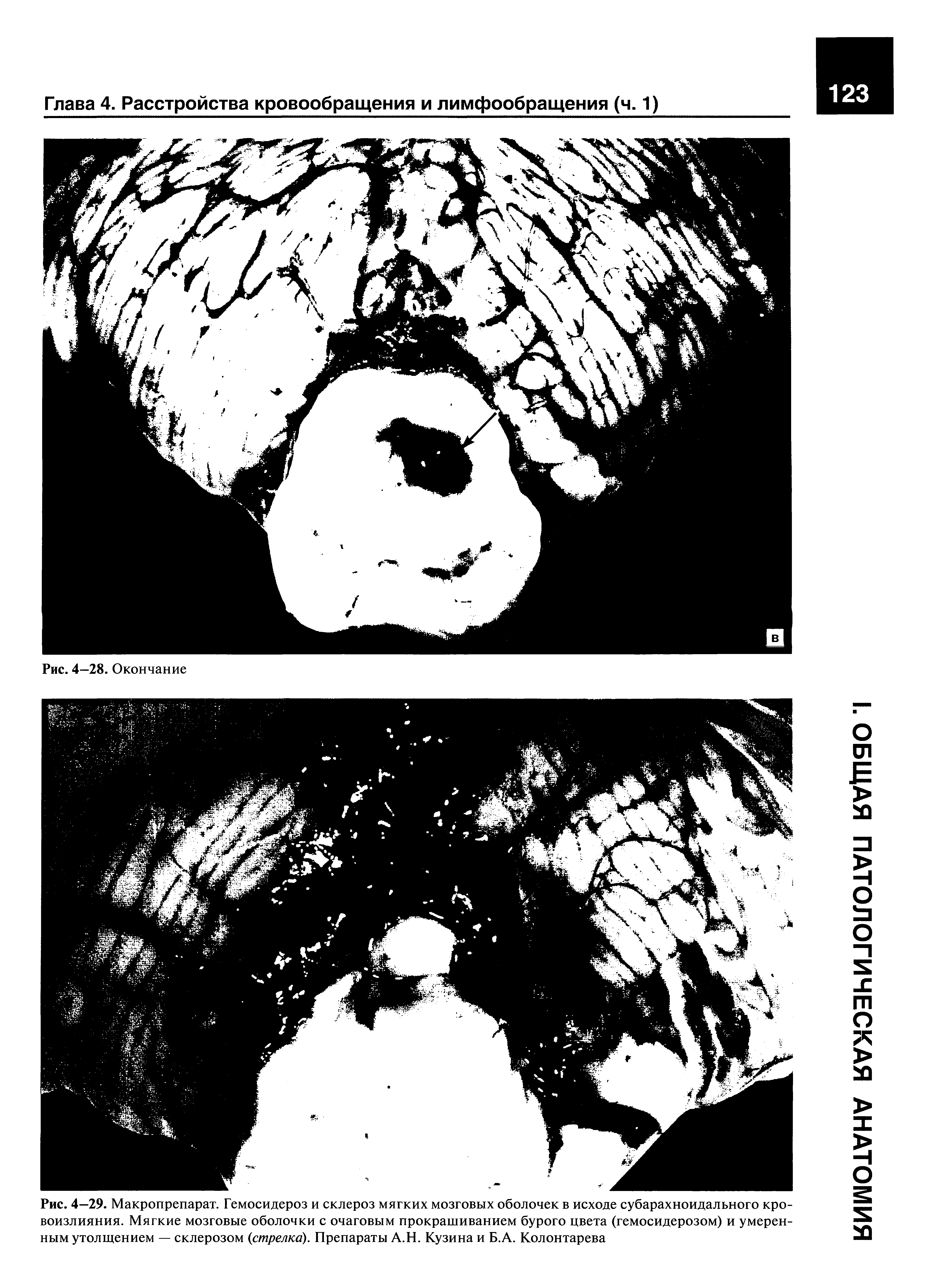 Рис. 4—29. Макропрепарат. Гемосидероз и склероз мягких мозговых оболочек в исходе субарахноидального кровоизлияния. Мягкие мозговые оболочки с очаговым прокрашиванием бурого цвета (гемосидерозом) и умеренным утолщением — склерозом (стрелка). Препараты А.Н. Кузина и Б.А. Колонтарева...