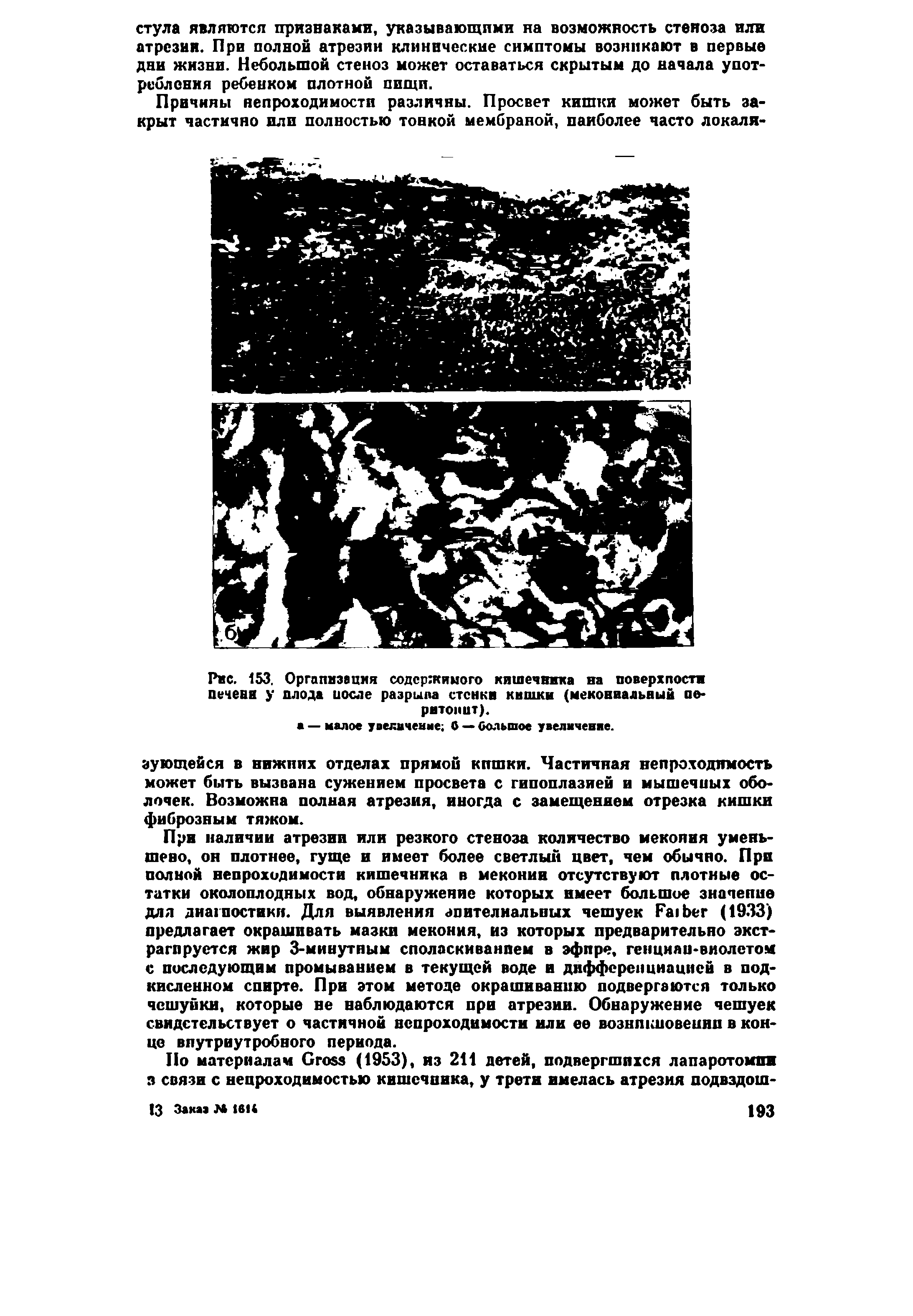 Рис. 153. Организация содержимого кишечника на поверхности печени у плода иосле разрыва стенки кишки (меконвальный перитонит).