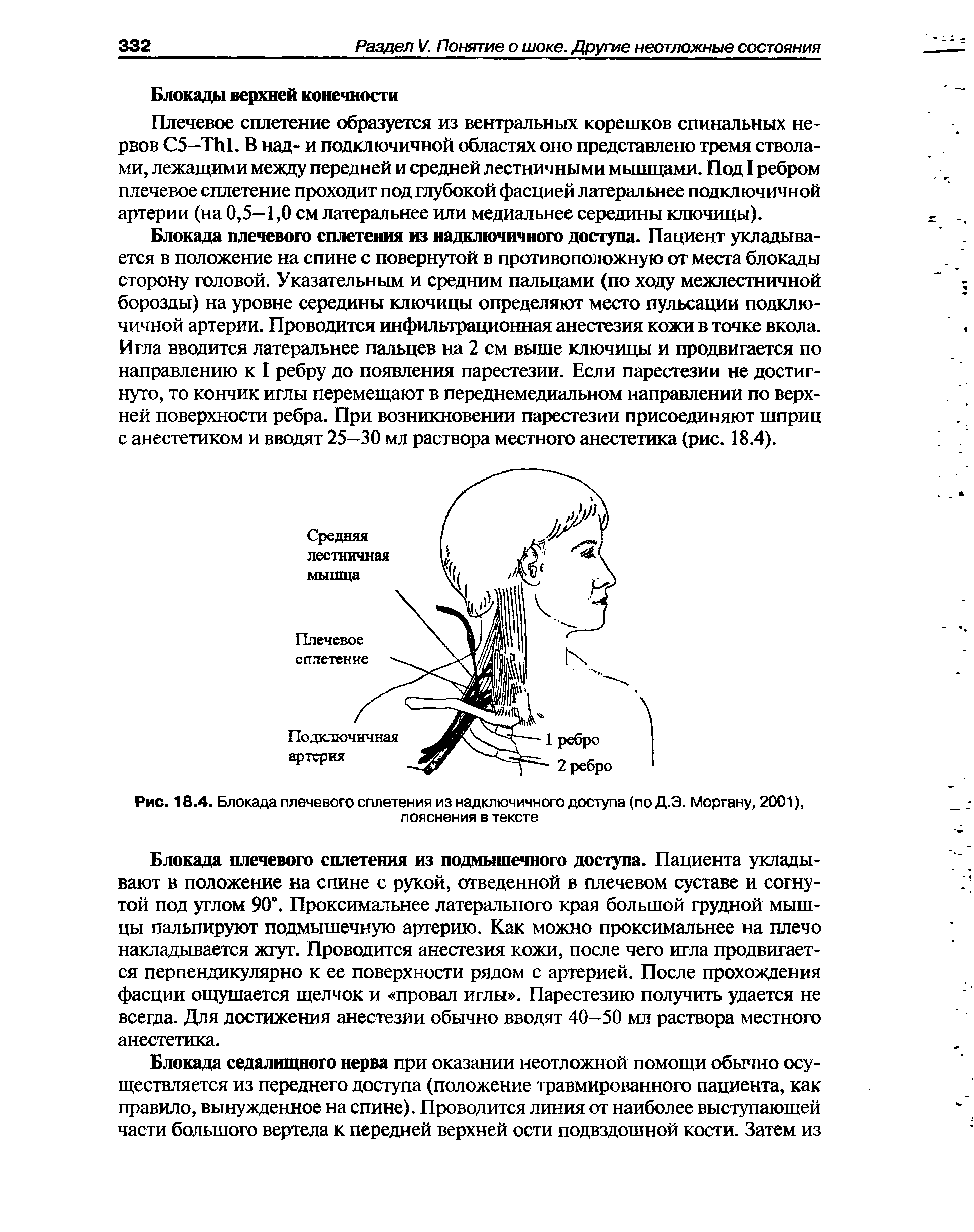 Рис. 18.4. Блокада плечевого сплетения из надключичного доступа (по Д.Э. Моргану, 2001), пояснения в тексте...
