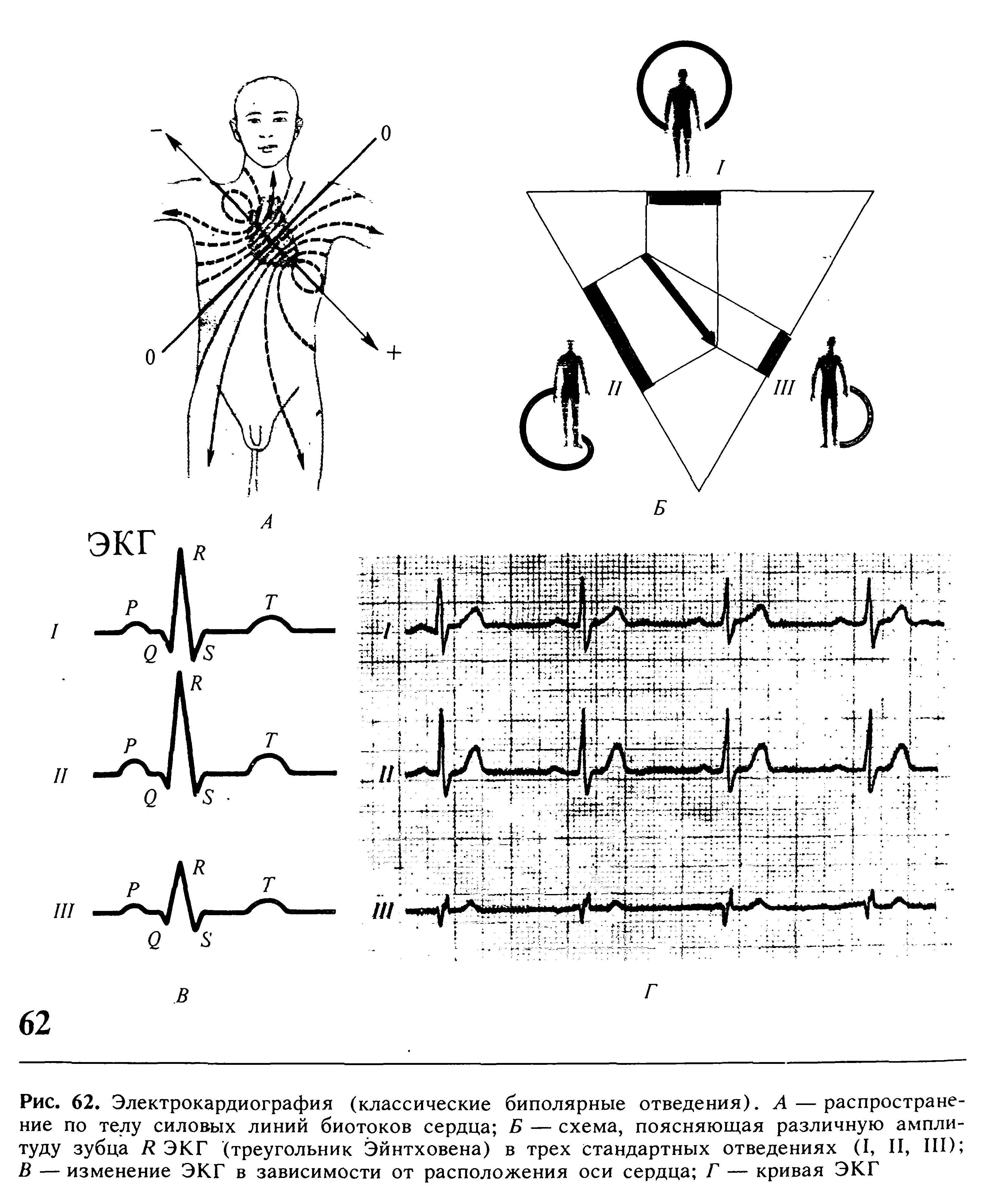 Рис. 62. Электрокардиография (классические биполярные отведения). А — распространение по телу силовых линий биотоков сердца Б — схема, поясняющая различную амплитуду зубца Б ЭКГ (треугольник Эйнтховена) в трех стандартных отведениях (I, II, III) В — изменение ЭКГ в зависимости от расположения оси сердца Г — кривая ЭКГ...