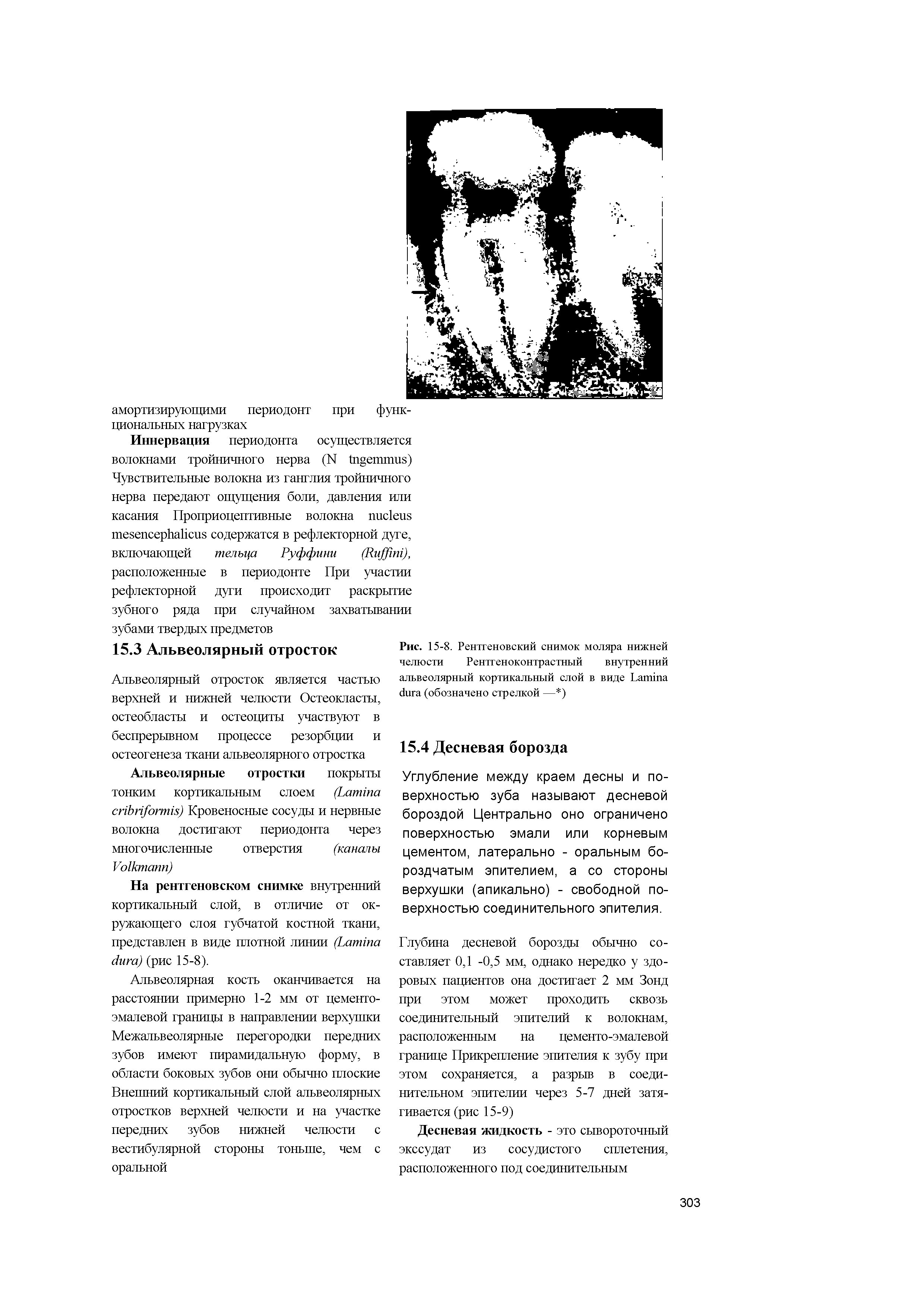 Рис. 15-8. Рентгеновский снимок моляра нижней челюсти Рентгеноконтрастный внутренний альвеолярный кортикальный слой в виде L (обозначено стрелкой — )...